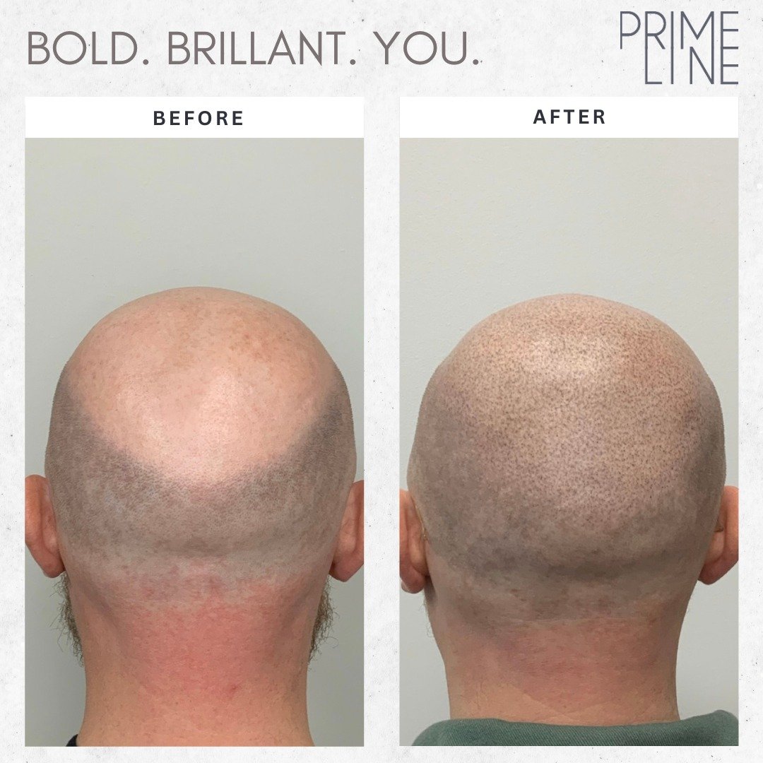 Ready to say goodbye to the frustration of dealing with hair loss? Our scalp micropigmentation treatments offer a permanent solution that's designed to help you look and feel your best. Schedule your consultation today and take the first step towards