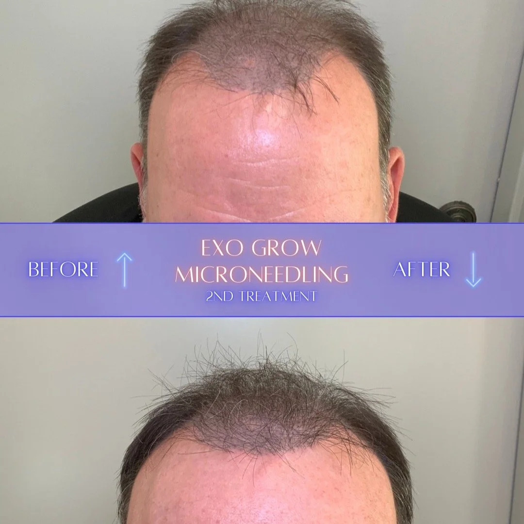 Results after two sessions of Exo-Grow Microneedling🔥
By combining the precision of microneedling with the regenerative power of high-potency exosomes, we are waking up dormant follicles and strengthening existing hair from the root. While hair rest