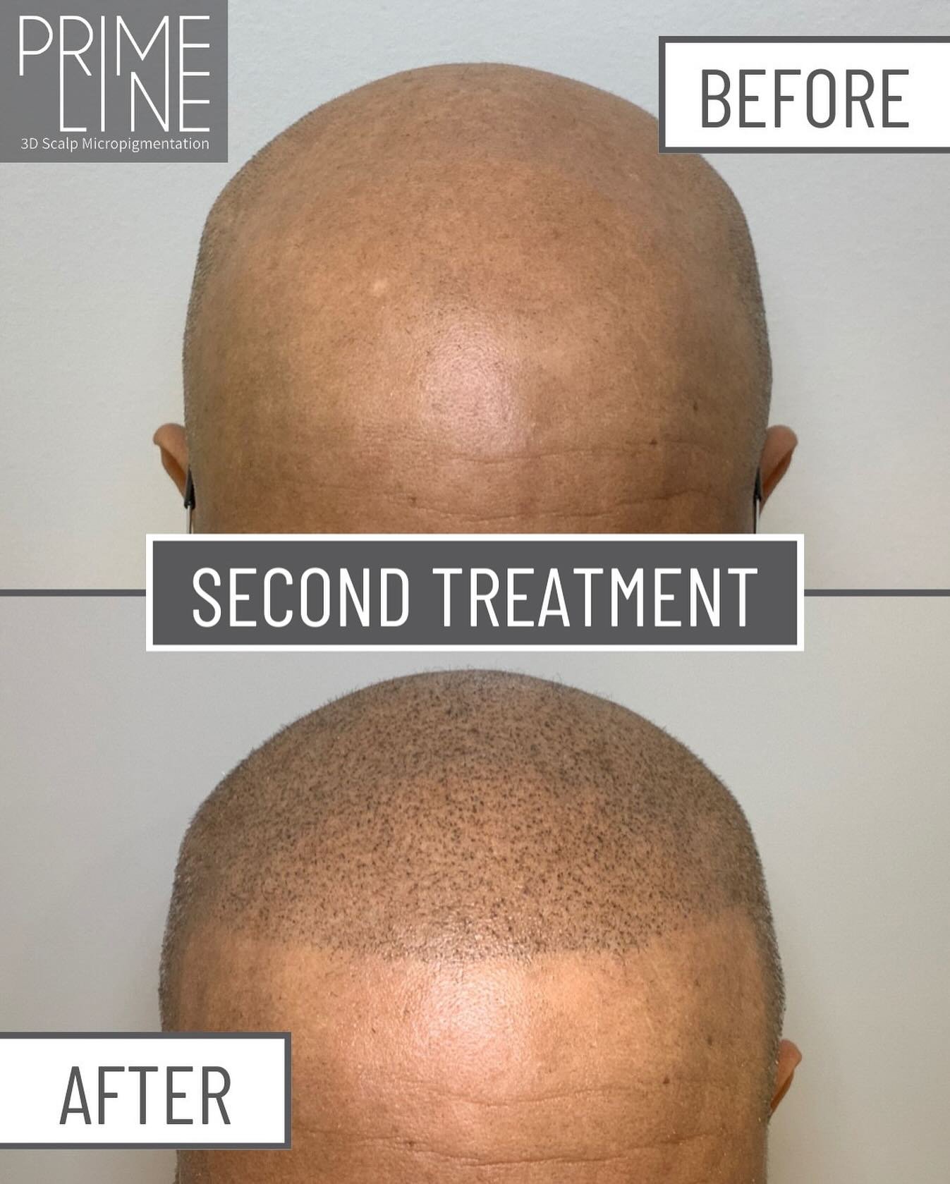 OKC Prime Line is more than a service; it&rsquo;s a life-changing transformation. Microscalp pigmentation provides a seamless, fuller look that brings back confidence.

Ready for a transformation of your own? Follow the 🔗 in my bio for more details.