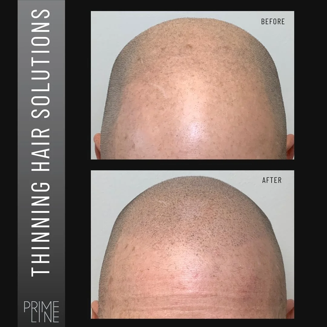 🎯 SMP can create a subtle, natural-looking hairline with tiny, pigment-matched deposits that mimic real hair follicles, or it can add density to thinning hair.
Perfect for filling in thinning areas or creating a clean, shaved look&mdash;without the 