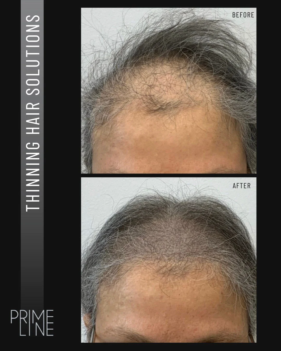 From Thin to Thick&mdash;Instantly! 👀🔥

The proof is in the results! 💯 SMP is the game-changing solution for thinning hair, restoring the look of density without surgery or downtime.

Book your consult and take your first step toward more density 
