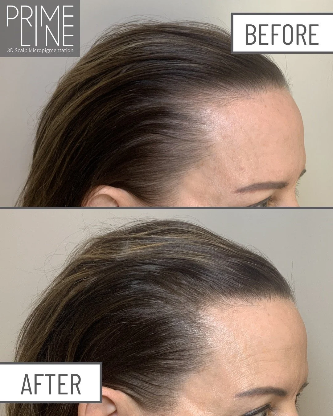 The power of just ONE session! ✨
Hair thinning is something so many women experience but rarely talk about. Take a look at these before-and-after photos from this client&rsquo;s very first Scalp Micropigmentation (SMP) session.
Even after just one ro