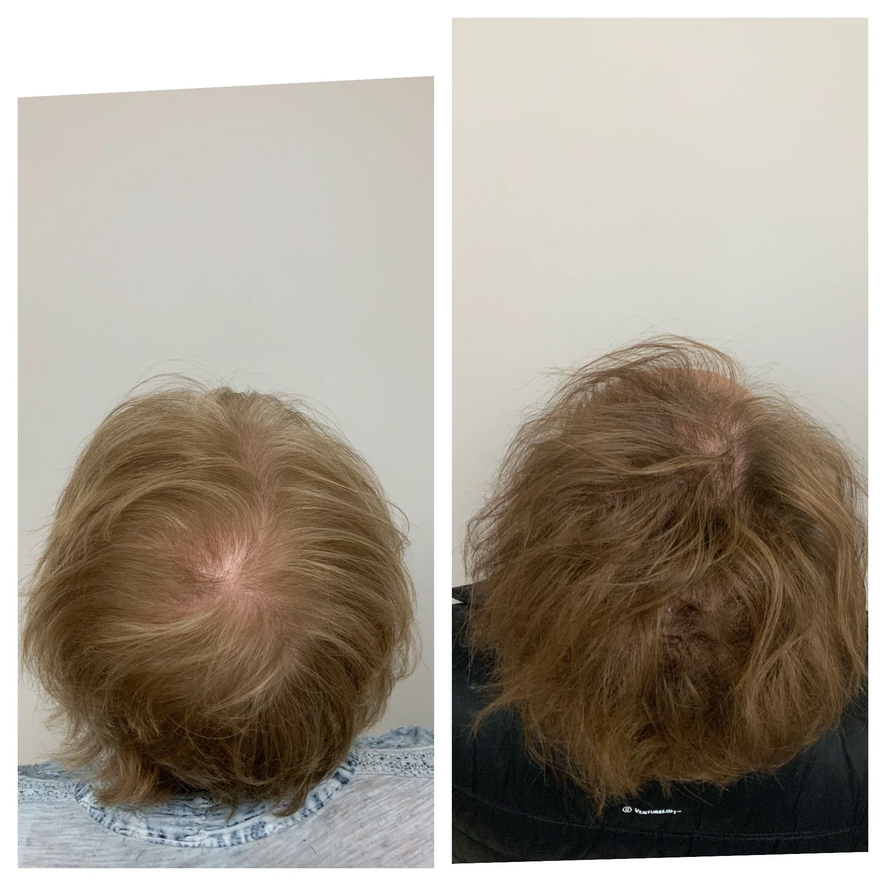 Scalp micropigmentation for women, women with thinning hair solutions.  Oklahoma, Texas, Kansas, Arkansas SMP, Prime Line OKC 