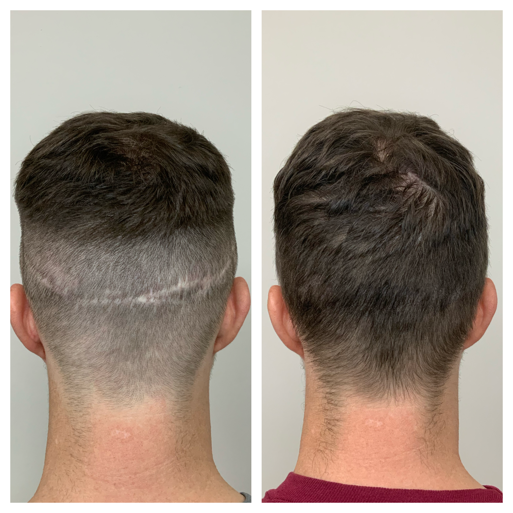 hair transplant scar camouflage in okc, hair transplant in oklahoma, FUE scar coverup, FUE scar camouflage 