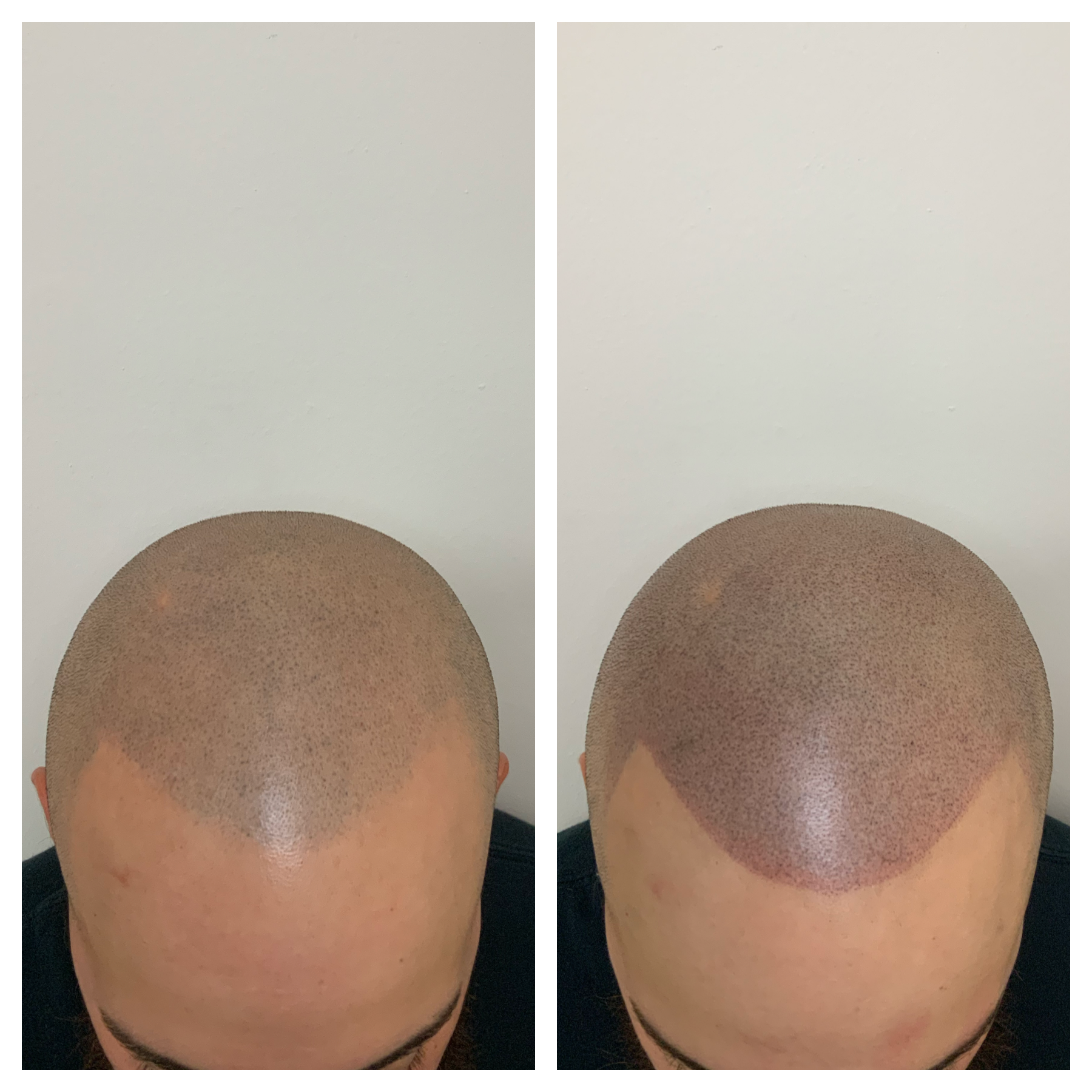 smp touchup, smp refresh in oklahoma, oklahoma city, tulsa, ok, scalp micropigmentation touchup 
