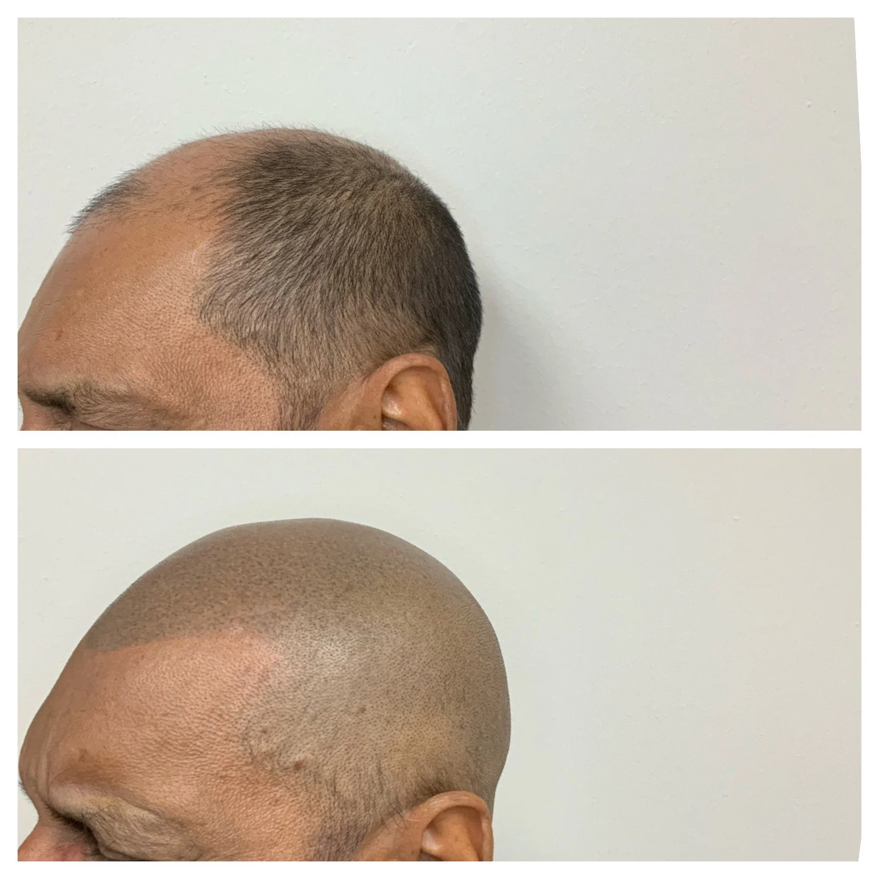 hair rejuvenation clinic, thinning hair clinic in oklahoma, scalp micro, scalp tattoo for balding hair, OKC, Kansas, Texas, Lawton, Tulsa, Oklahoma, prime line okc 
