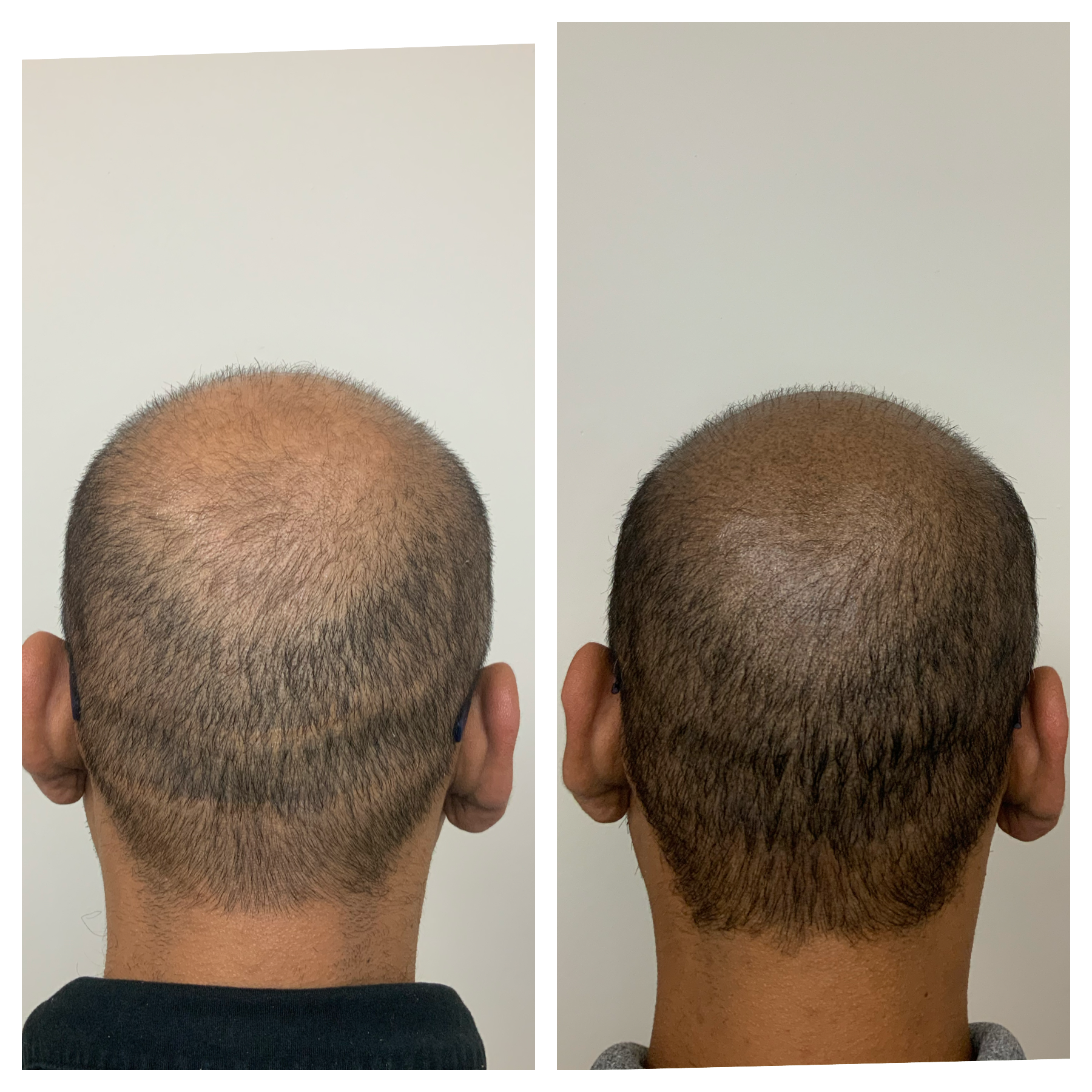 thinning hair treatment oklahoma, thinning hair treatment kansas, thinning hair treatment texas, prime line okc 