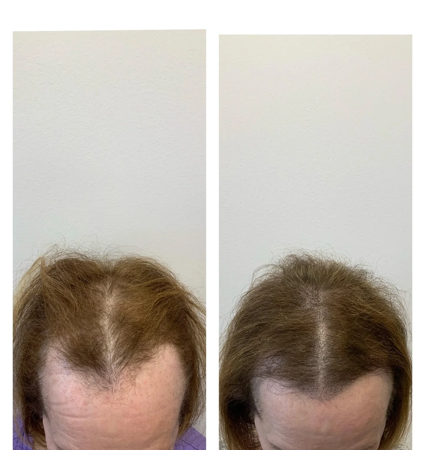 thinning hair for women | balding hair | SMP for women | scalp Micropigmentation | hair treatment options for women 