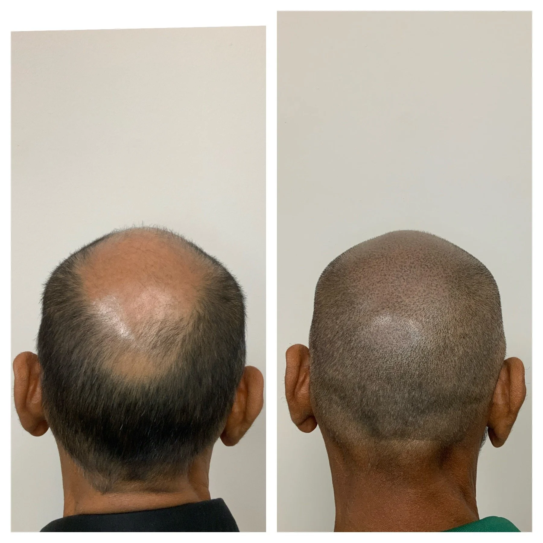 receding hairlines | SMP oklahoma city ok | Edmond, OK, Texas, Kansas SMP