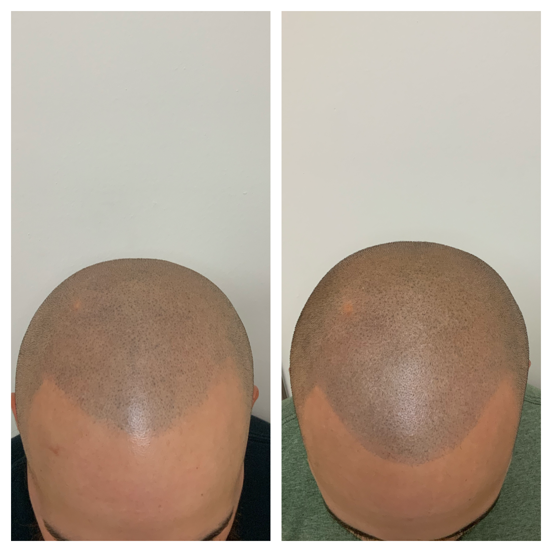 SMP touchup, scalp micropigmentation touchup in Oklahoma, Texas, Kansas, Arkansas, SMP coverup