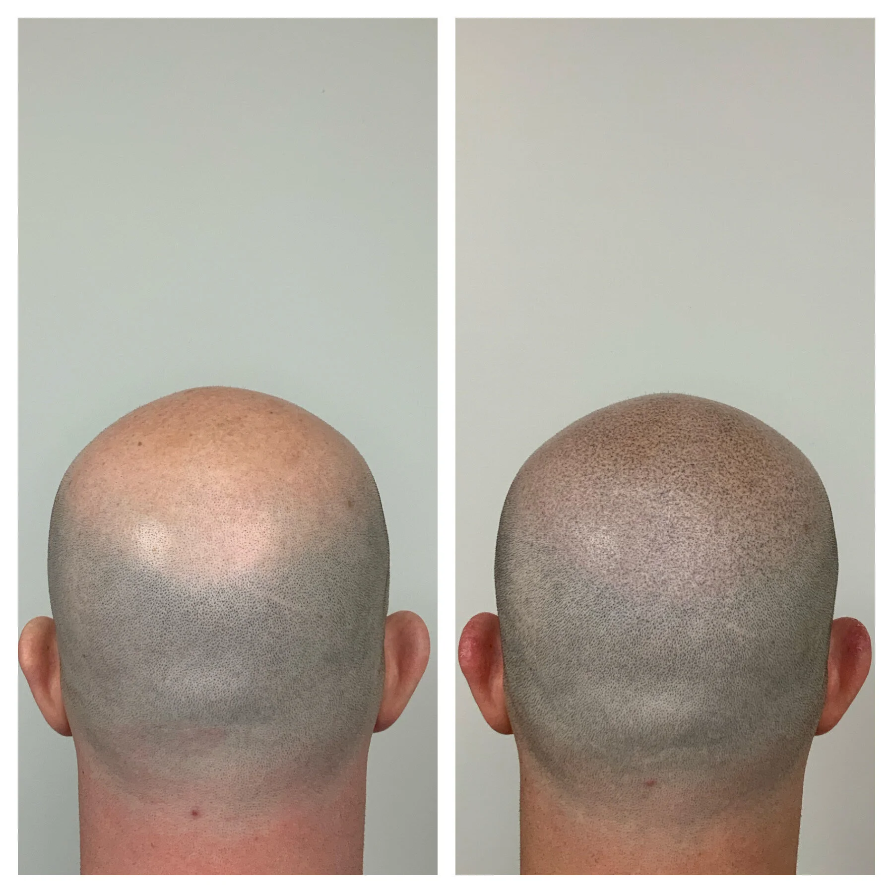 hairtattoo oklahoma, barber, okc, balding hair men, smp okc metro, prime line okc scalp micro pigmentation 