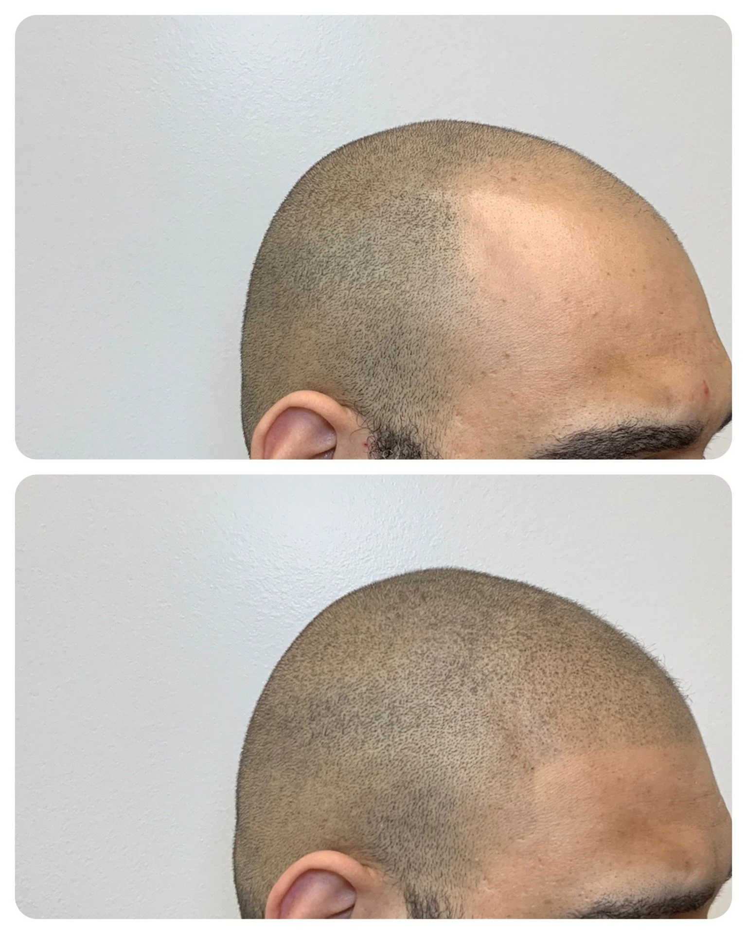 MEDICAL TATTOO | SCALP TATOO | HAIR RESTORATION | HAIR TRANSPLANT | PRIME LINE OKC 