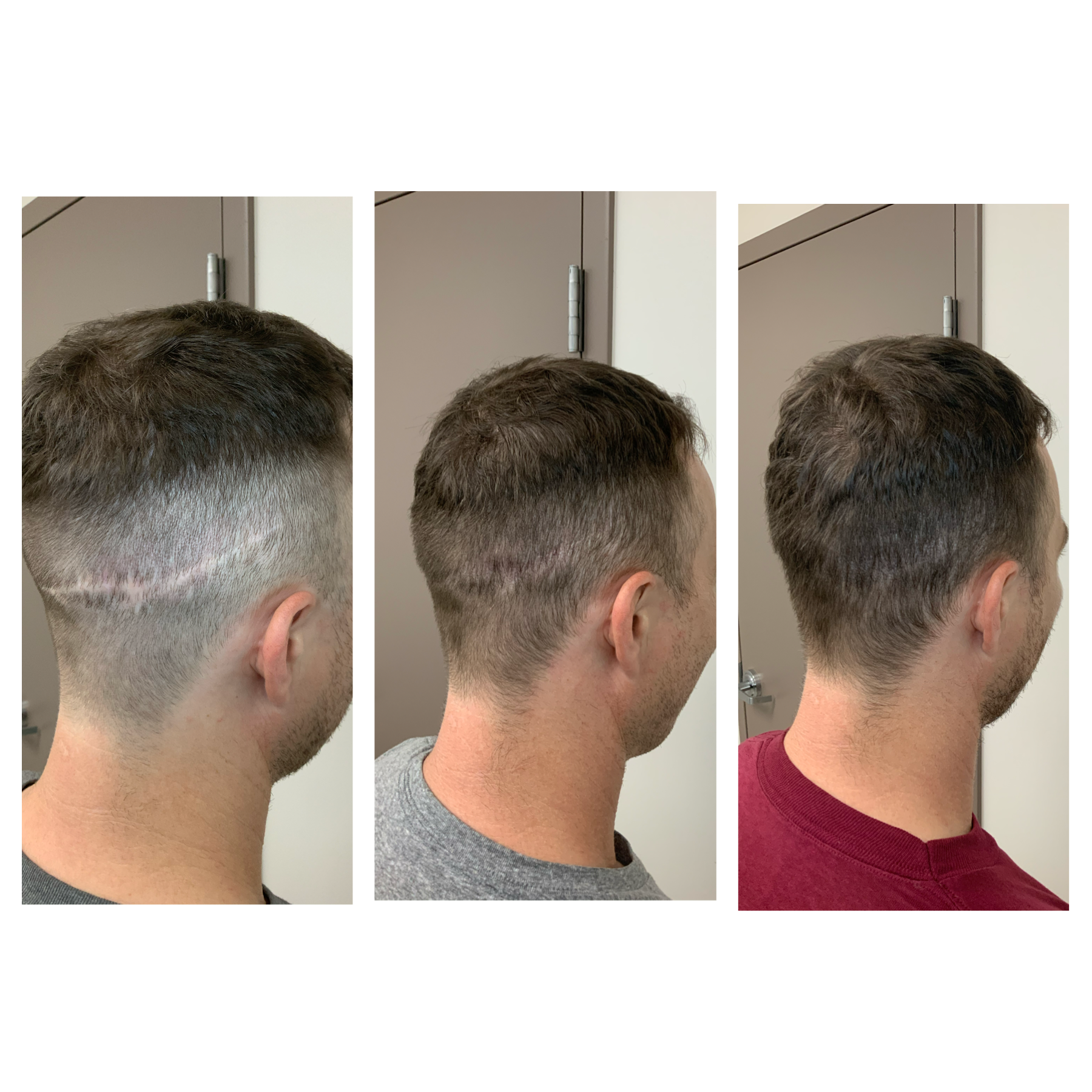 healing stages of SMP, healing of hair transplant scar camouflage in Oklahoma, SMPOKC 