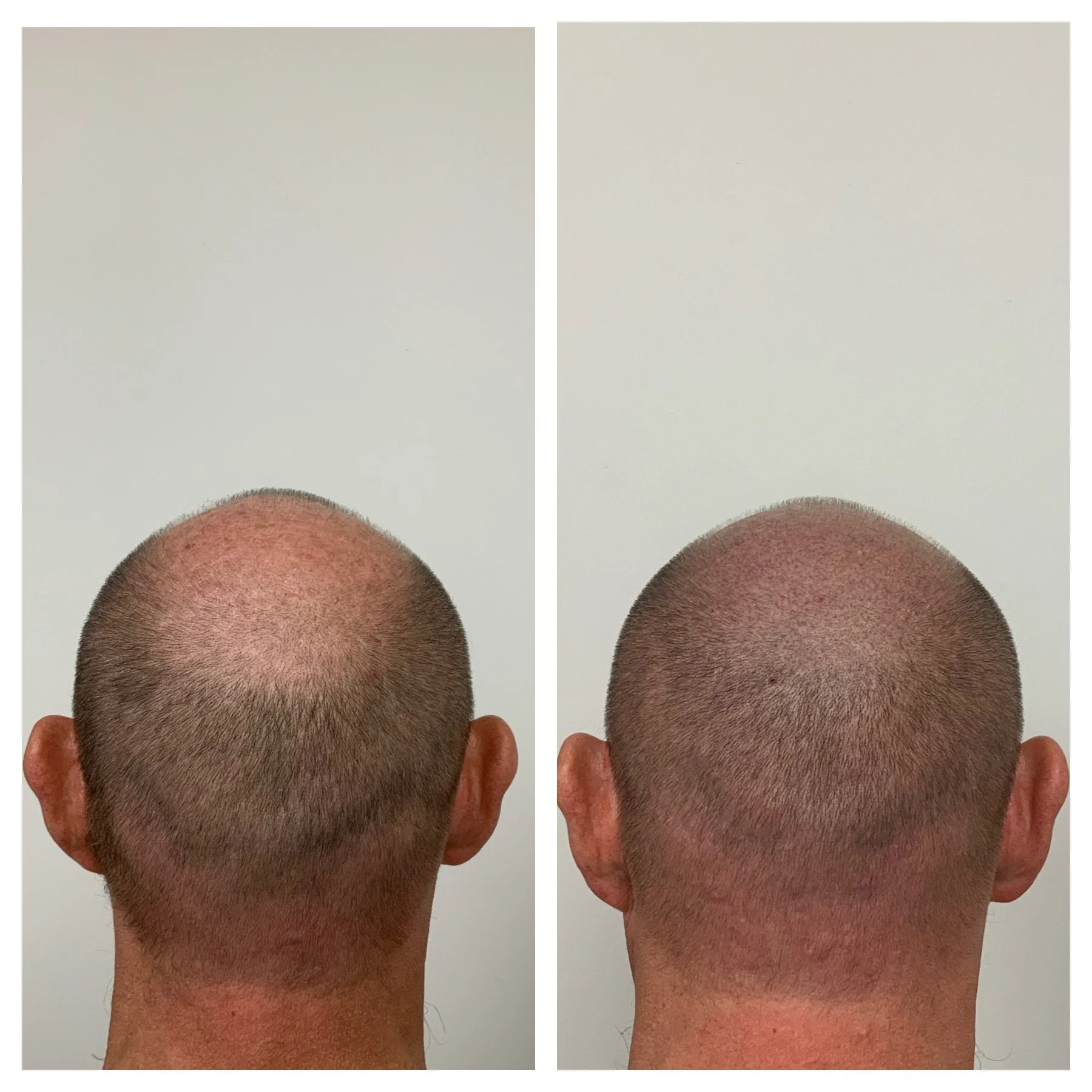 SMP OKC, scalp micropigmentation in Oklahoma, Prime Line OKC 
