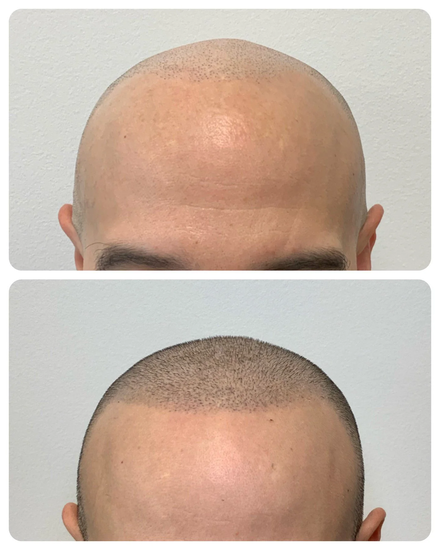 Men's thinning and balding hair | hair restoration | hair treatment | scalp Micropigmentation in Oklahoma | Prime Line OKC | SMP 