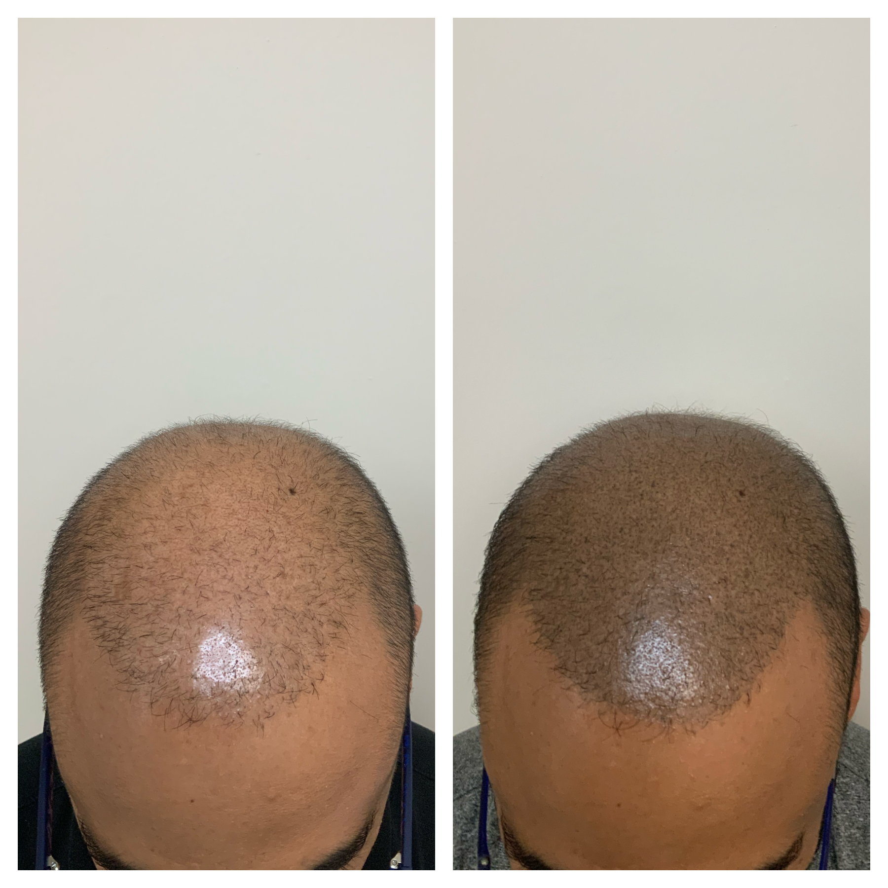 smp okc, scalp miropigmenation in oklahoma, scalp micropigmentation us 