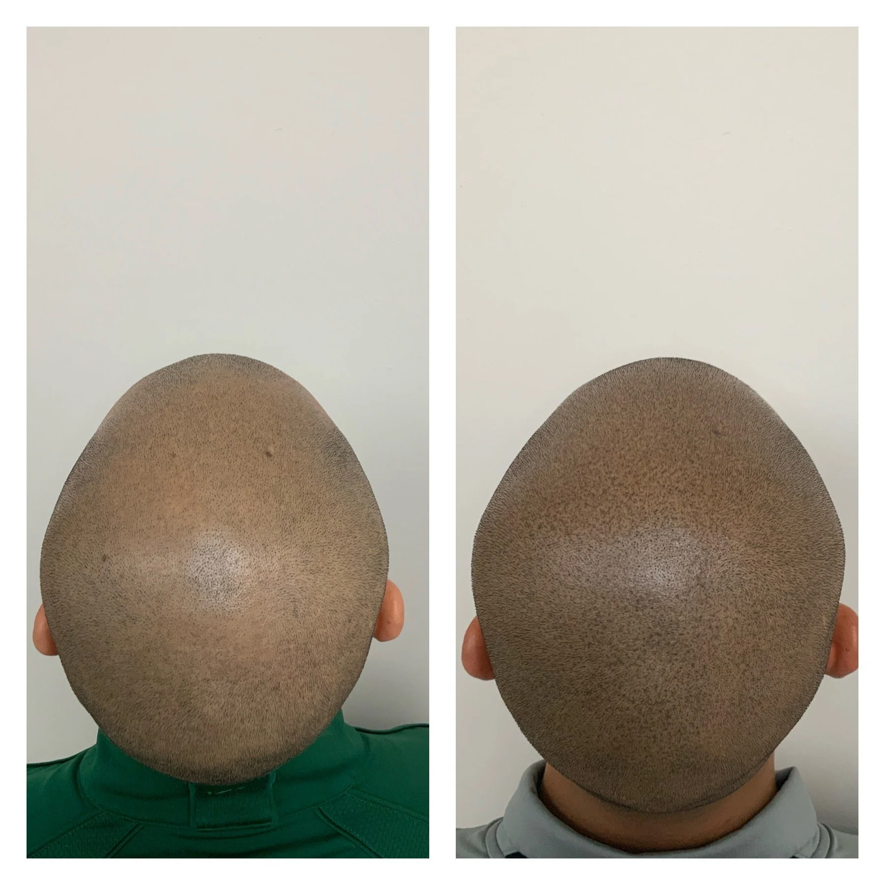 scalp micropigmentation| OKC metro for thinning or balding hair | Prime Line OKC | hair transformation 