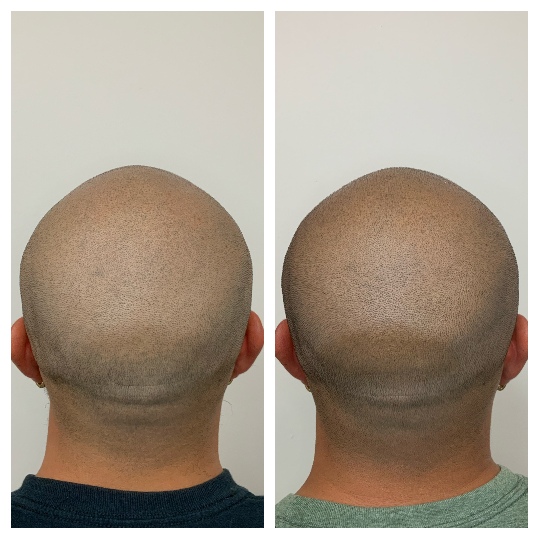 prime line okc smp touchup, color refresh for smp, scalp tattoo touchup in okc 