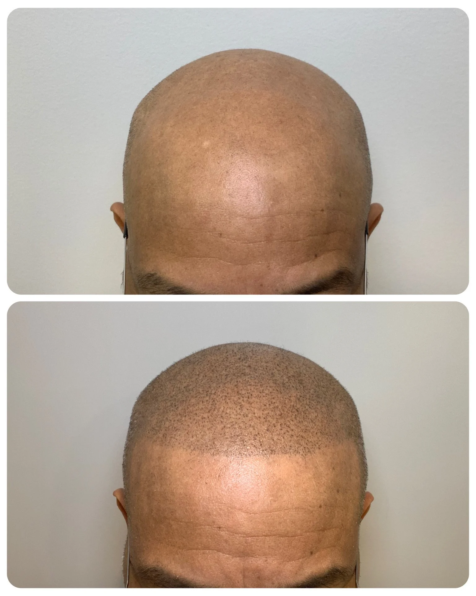 scalp micro pigmentation full scalp 