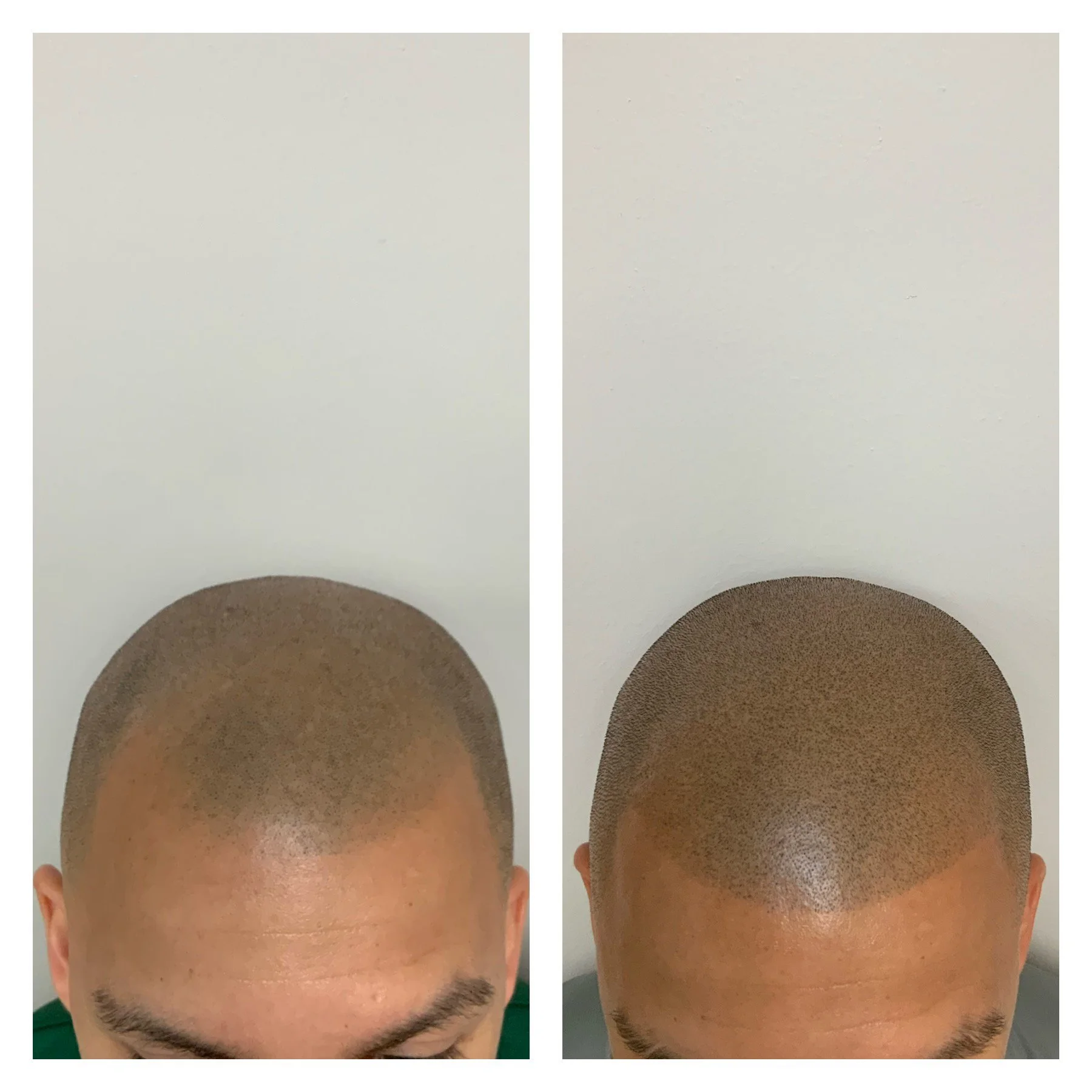 thinning hair SMP, scalp micro pigmentation in oklahoma, SMP touchup, new hairline 