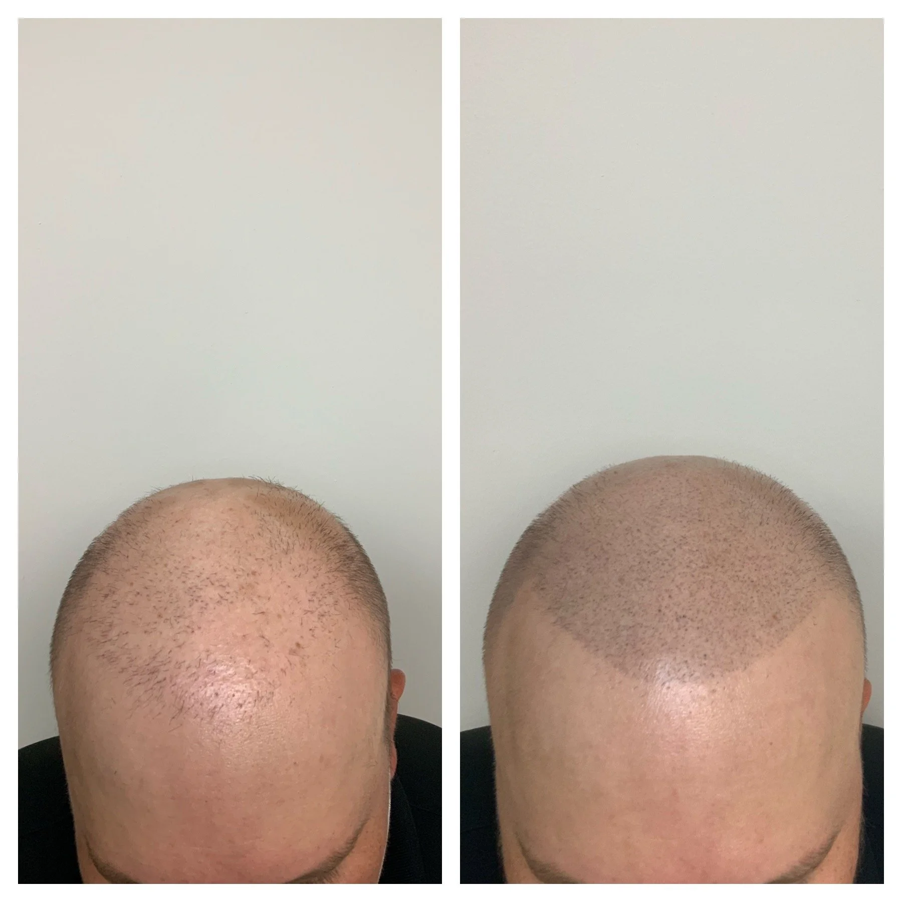 balding treatment edmond oklahoma | All photos are Copyright of Prime Line Okc.