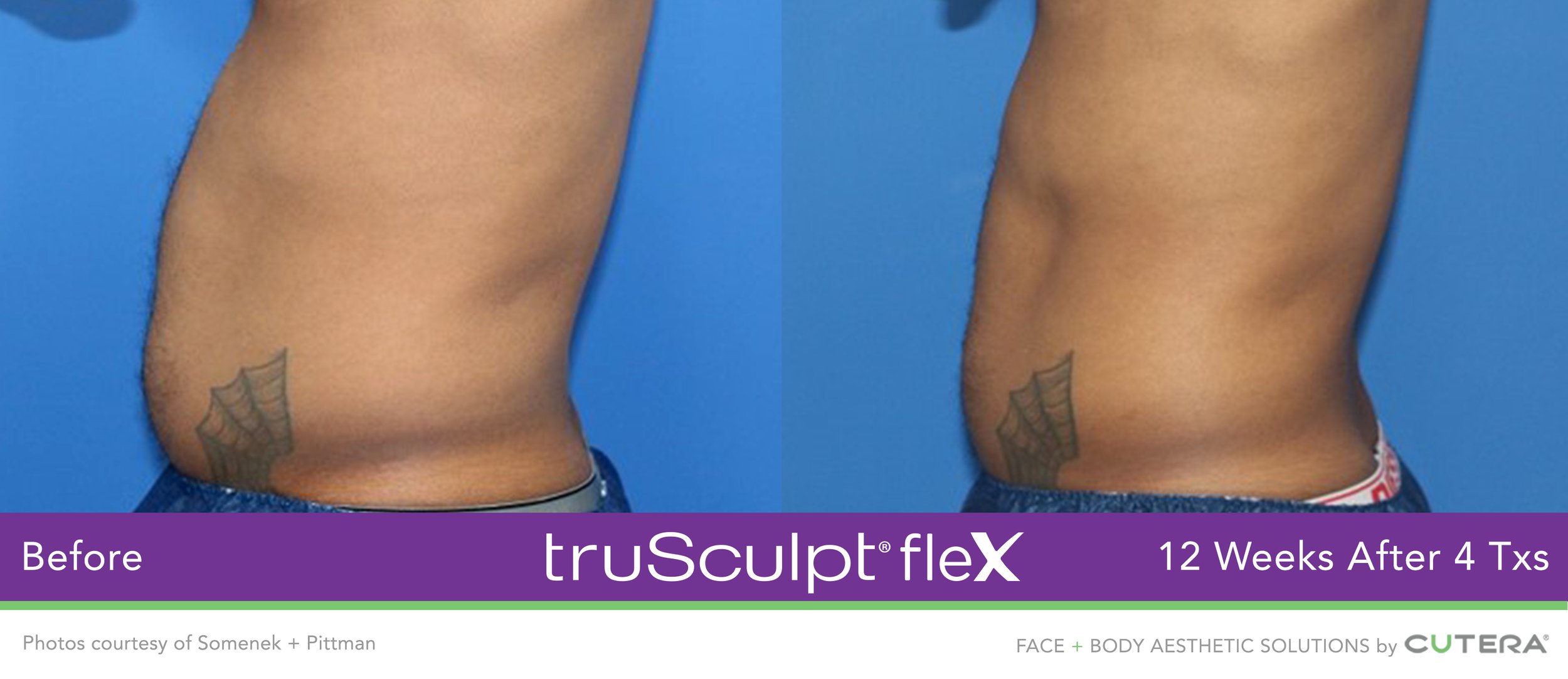 AP002903-truSculpt-flex-Somenek-Pittman-SetC-(1).jpeg