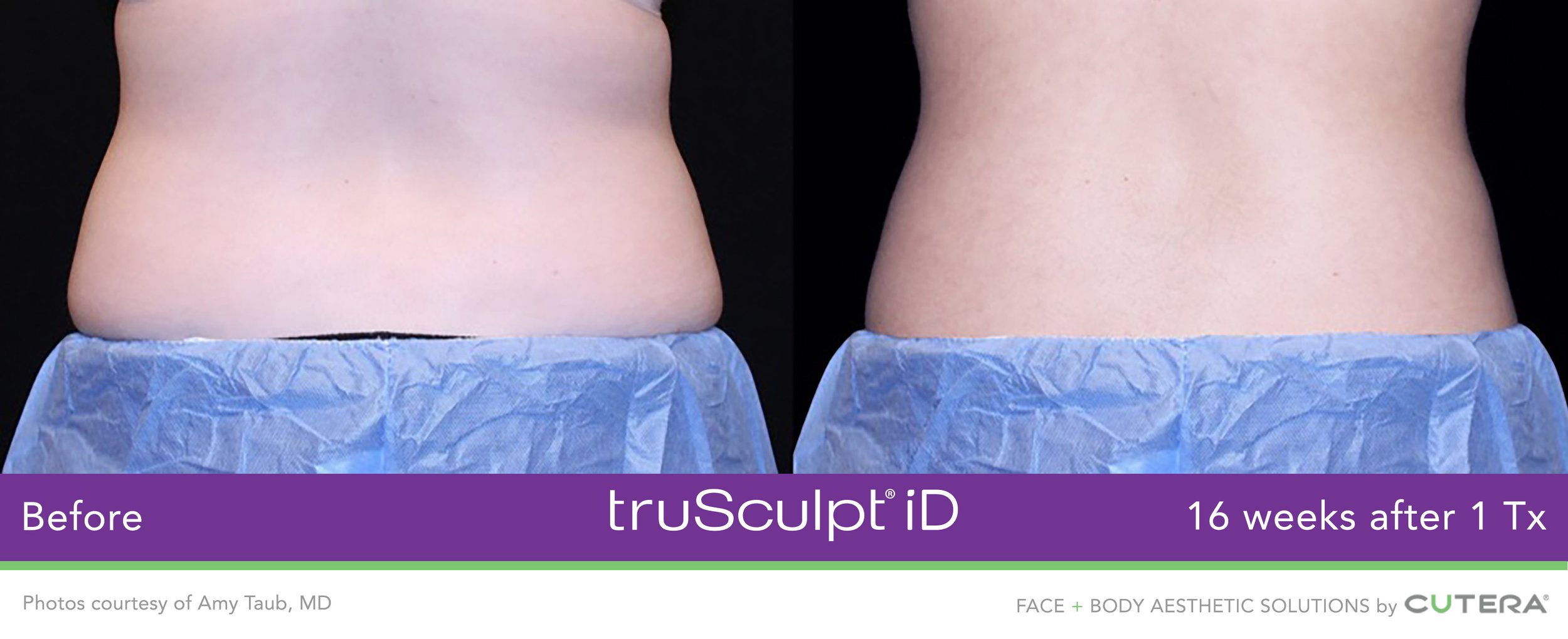 truSculpt-iD-Amy-Taub-MD-1.jpeg