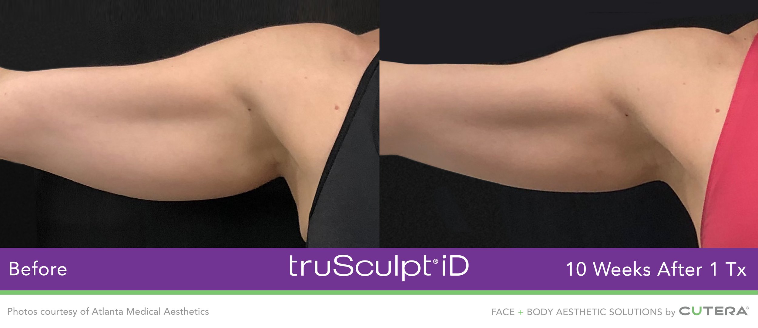 truSculpt-iD-Atlanta-Medical-Aesthetics.jpeg