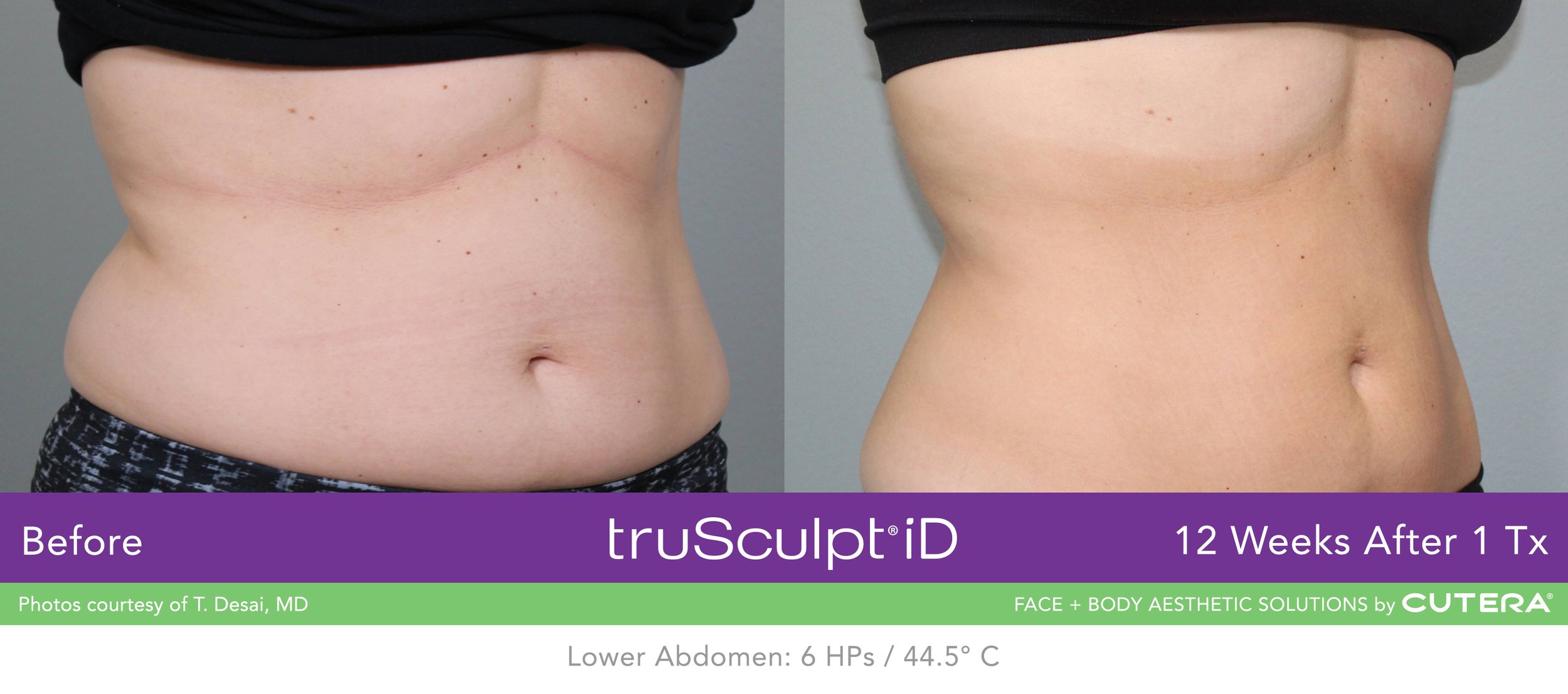 truSculpt-iD-B-A-T-Desai-A.jpeg