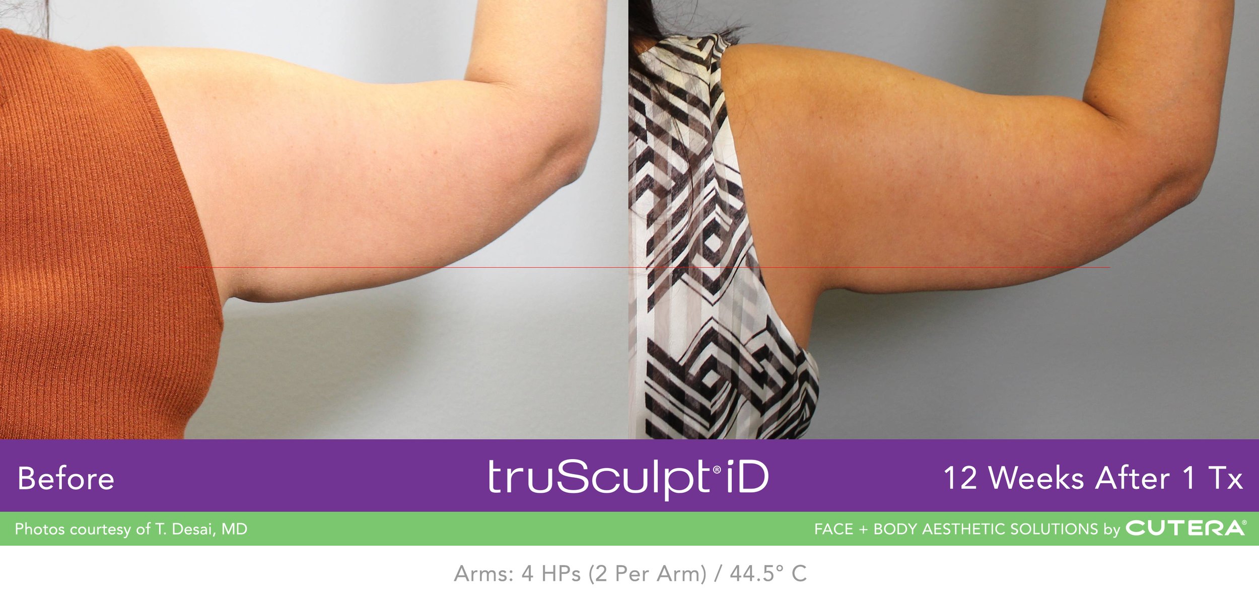 truSculpt-iD-B-A-T-Desai-B.jpeg