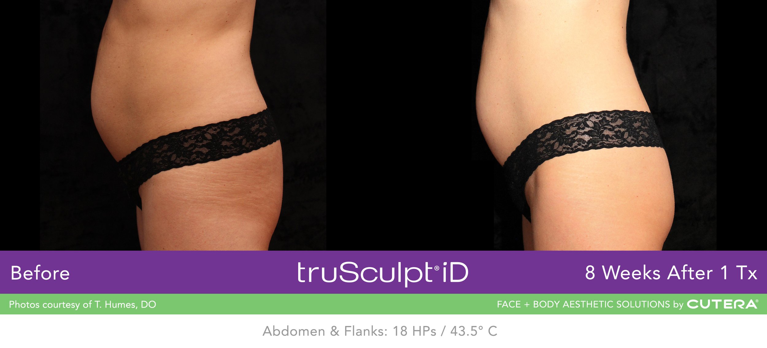 truSculpt-iD-Humes-8-Weeks-1Tx.jpeg