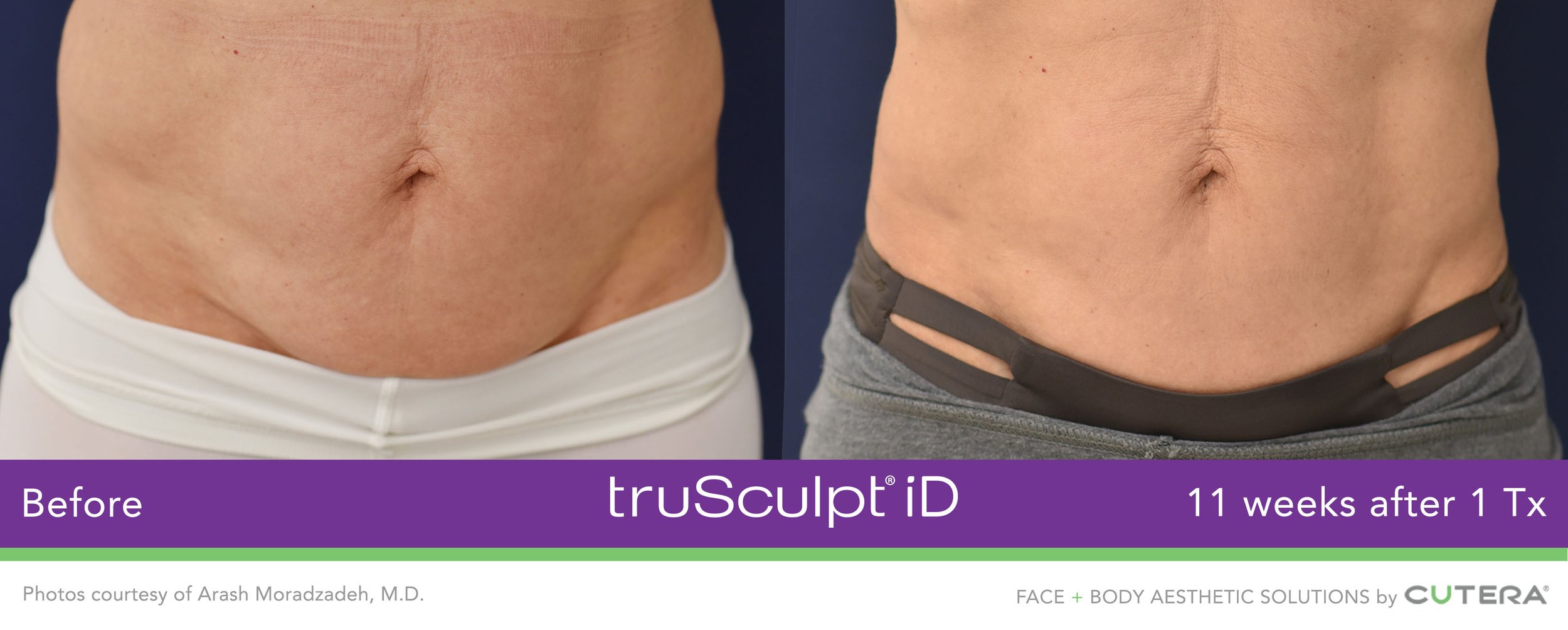 AP2201-truSculpt-iD-Arash-Moradzadeh-MD-1.jpeg