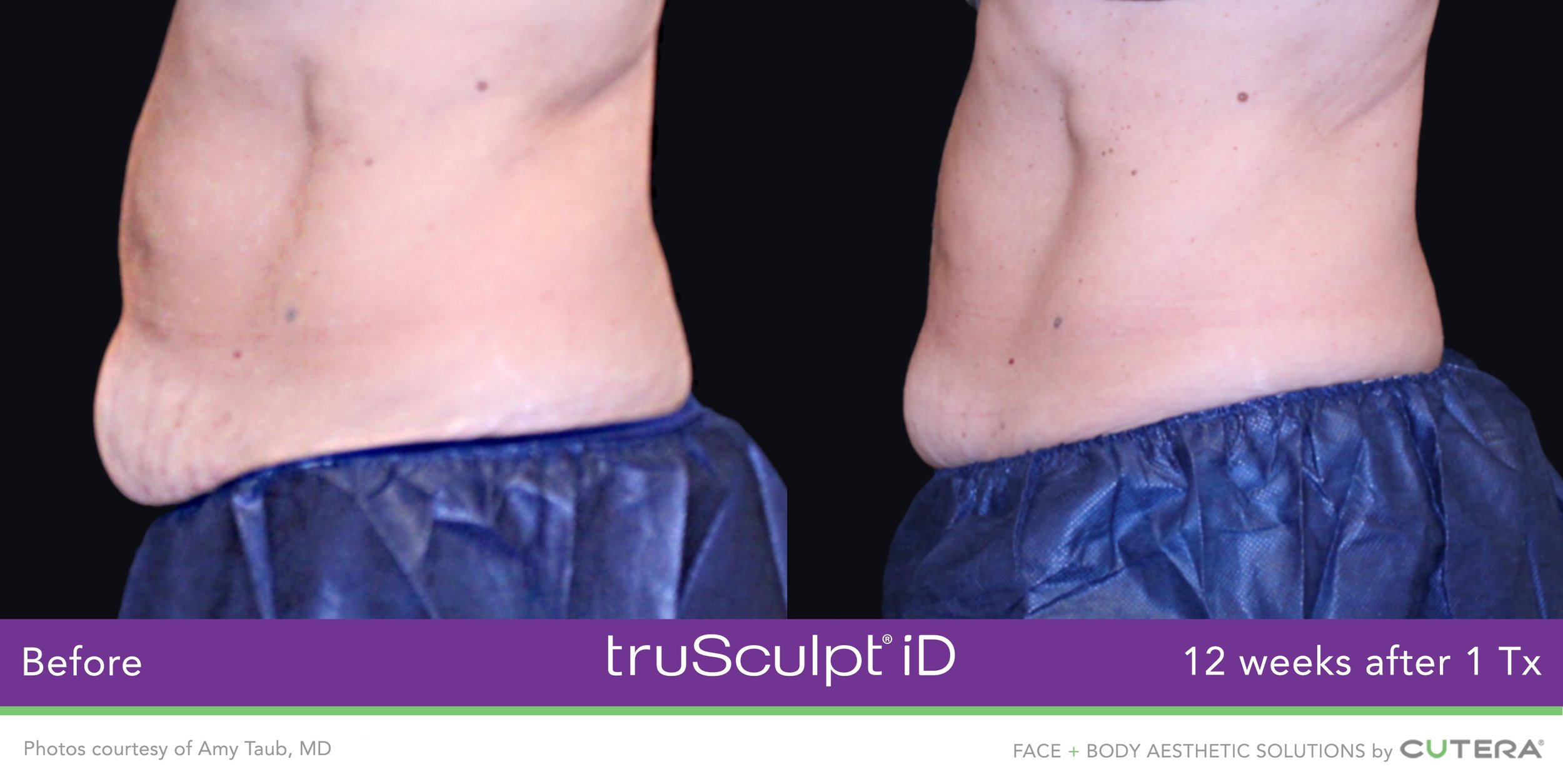 truSculpt-iD-Amy-Taub-MD-2.jpeg