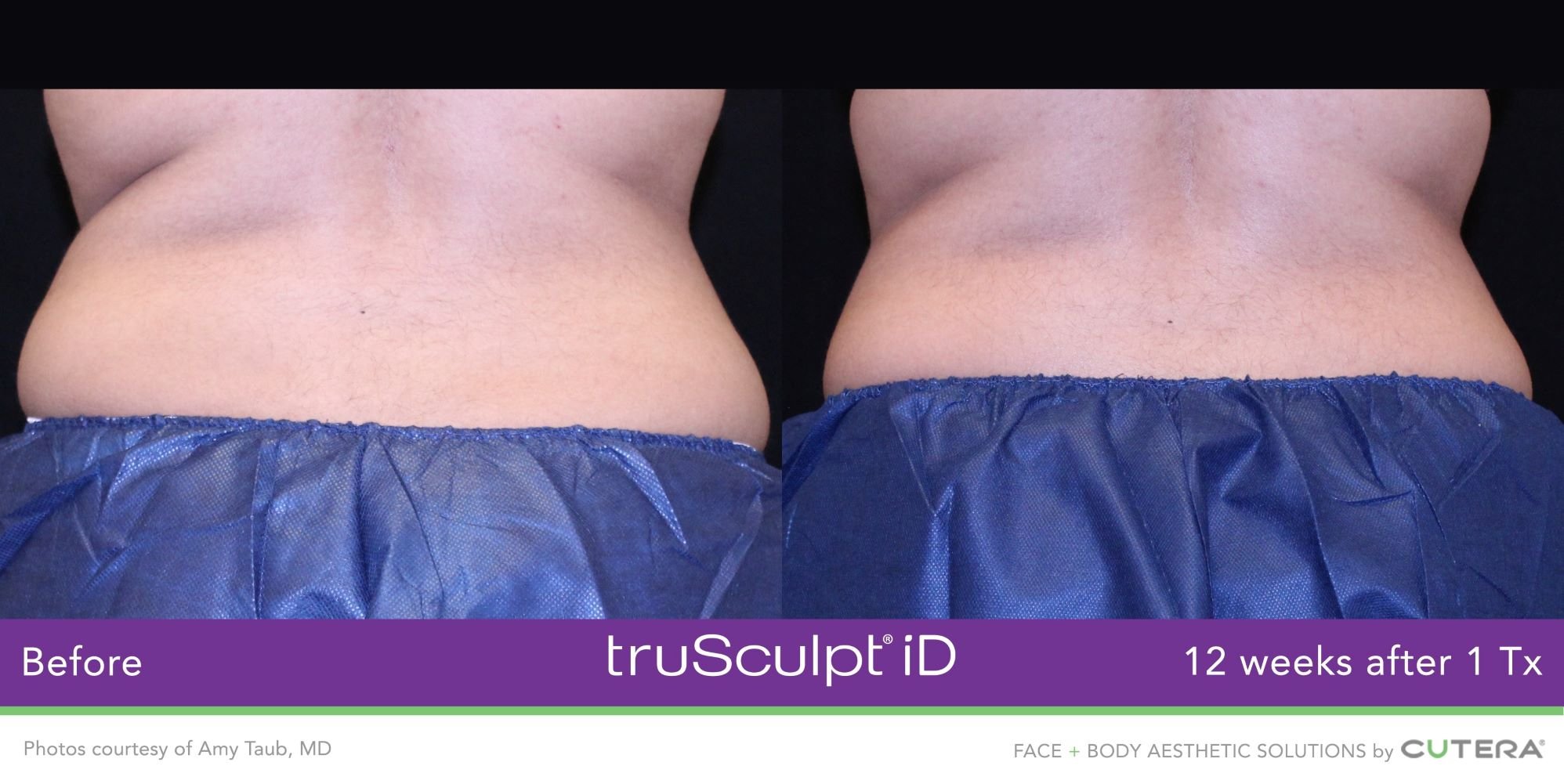 truSculpt-iD-Amy-Taub-MD-4.jpeg