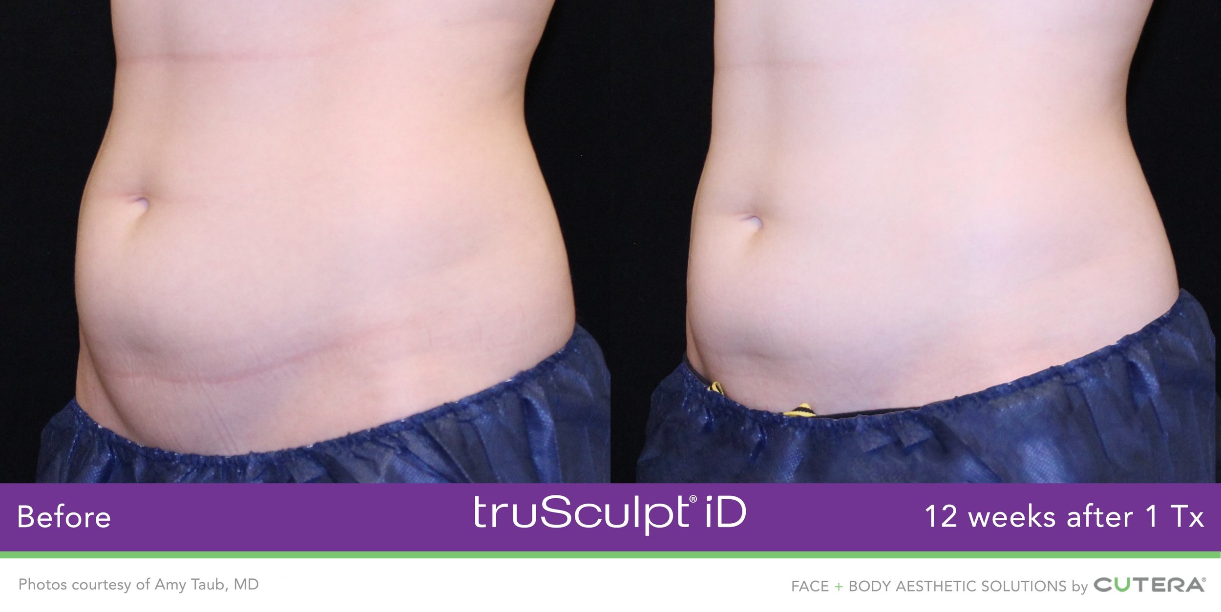 truSculpt-iD-Amy-Taub-MD-3.jpeg