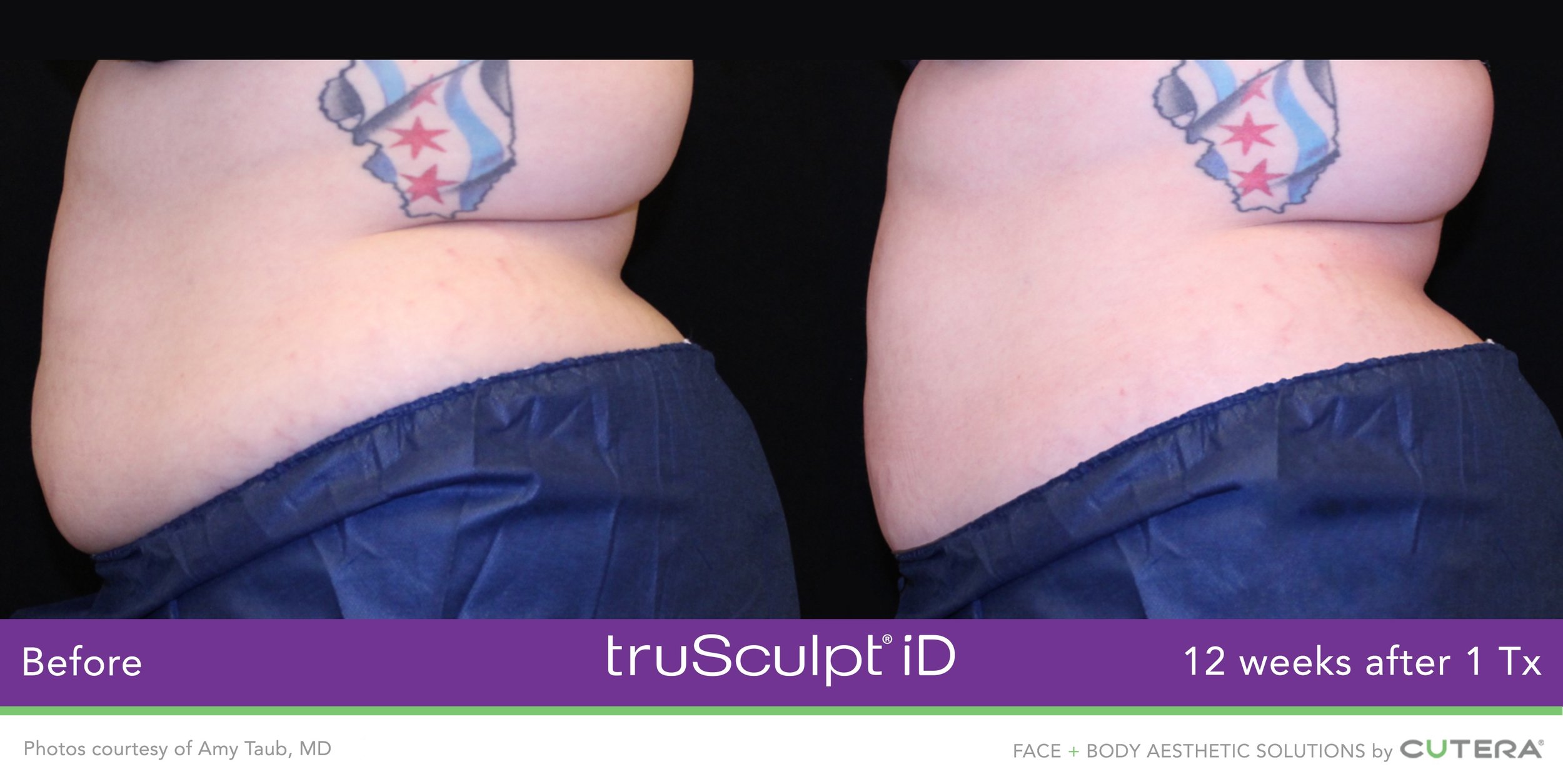 truSculpt-iD-Amy-Taub-MD-6.jpeg