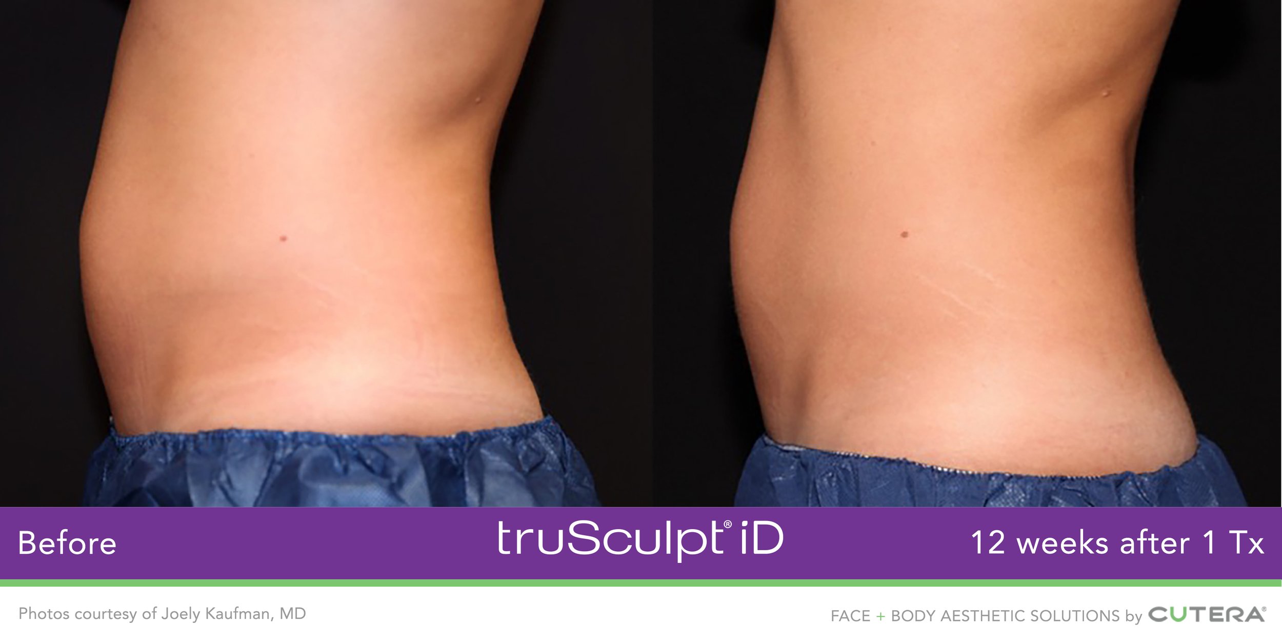 truSculpt-iD-Joely-Kaufman-MD-1.jpeg