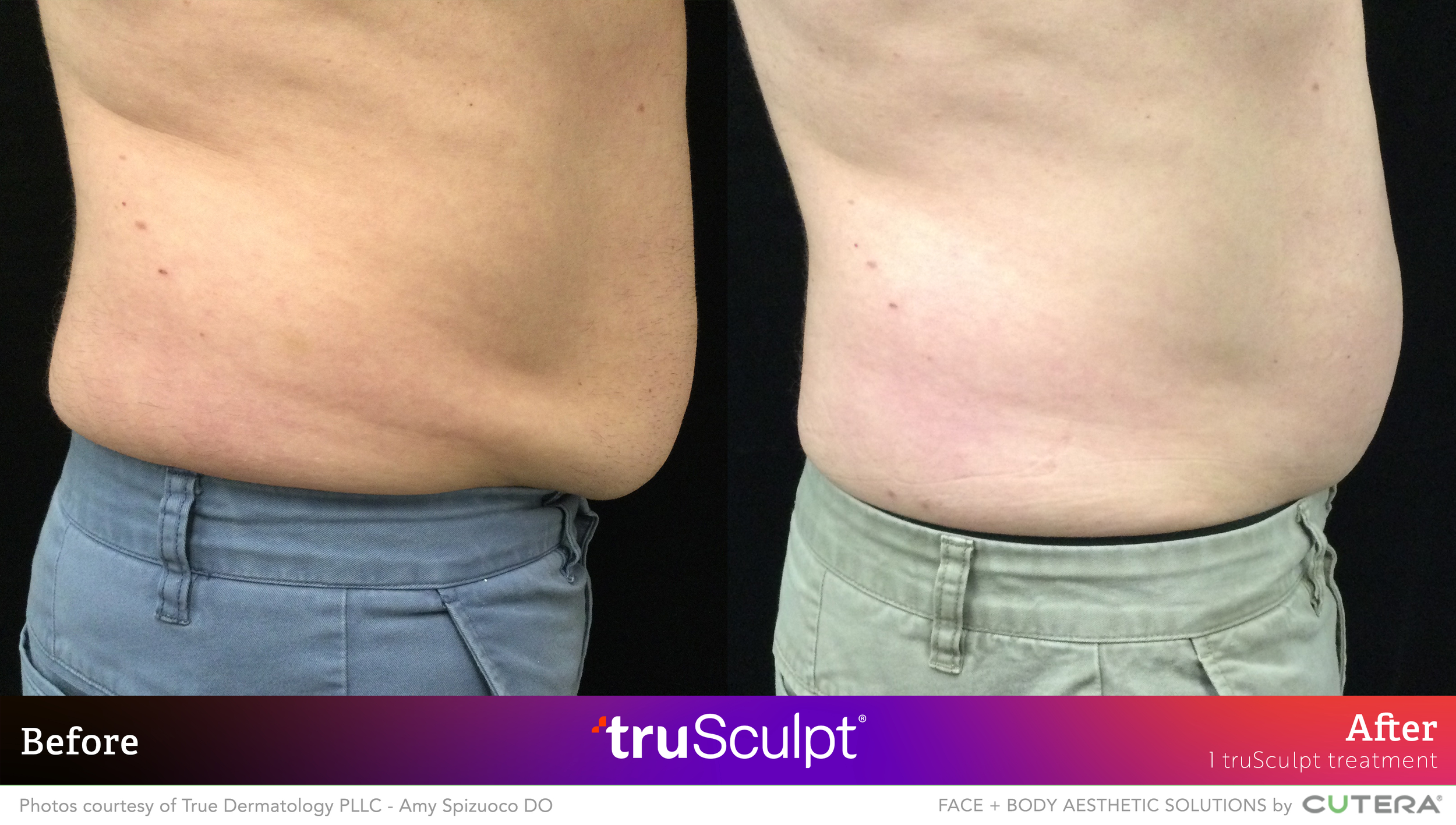 06_truSculpt ID_B&A_True Dermatology.png