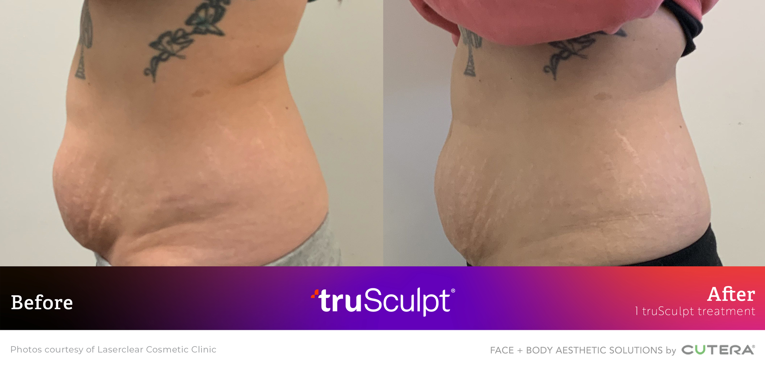 truSculpt iD-Laserclear Cosmetic Clinic-left.png