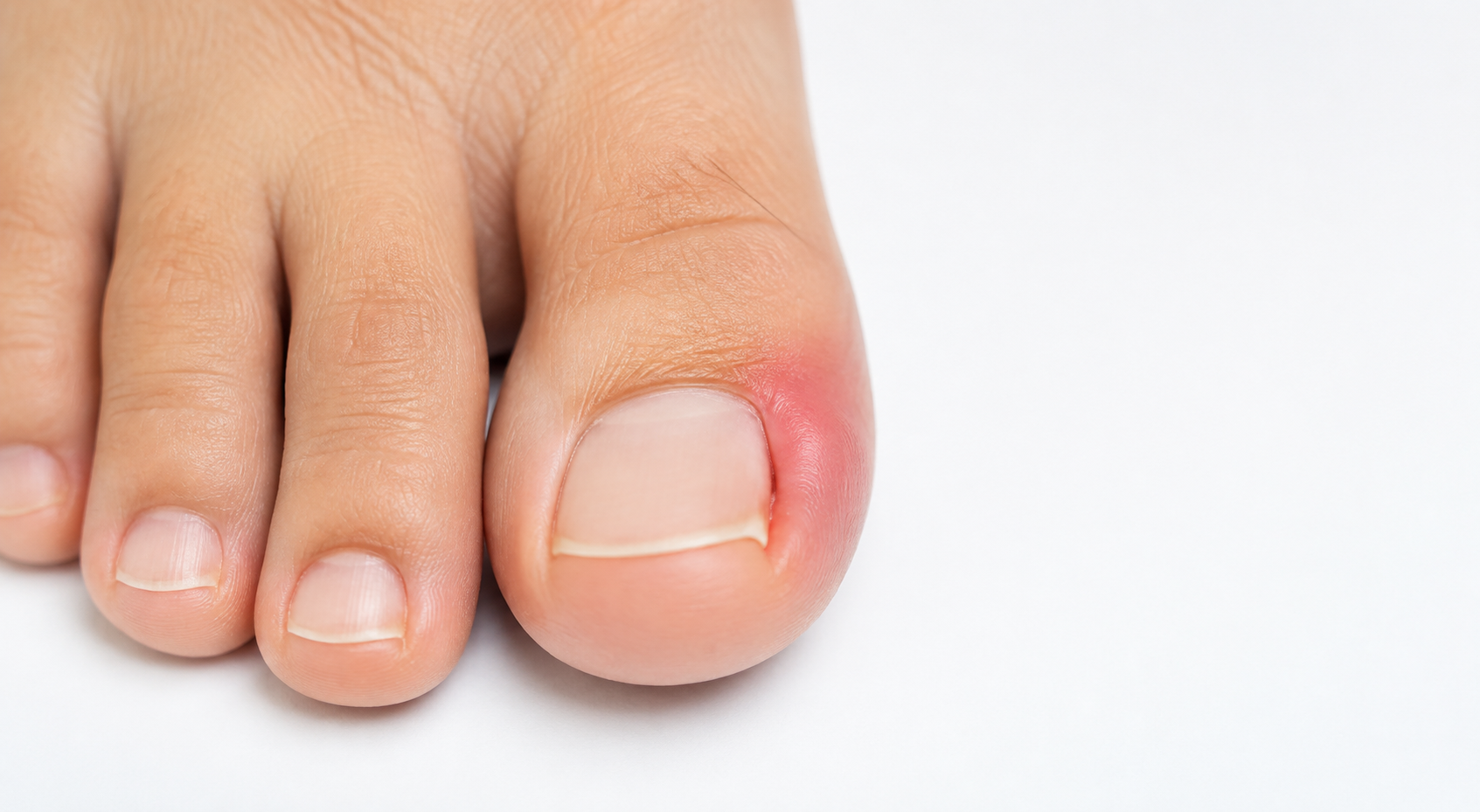 Ingrown nail.