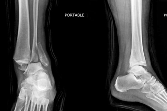 Ankle Fractures — Dr. Woojung Lee, DPM, Modern Podiatry - Foot & Ankle  Clinic - Board certified Podiatrist in Frisco, TX