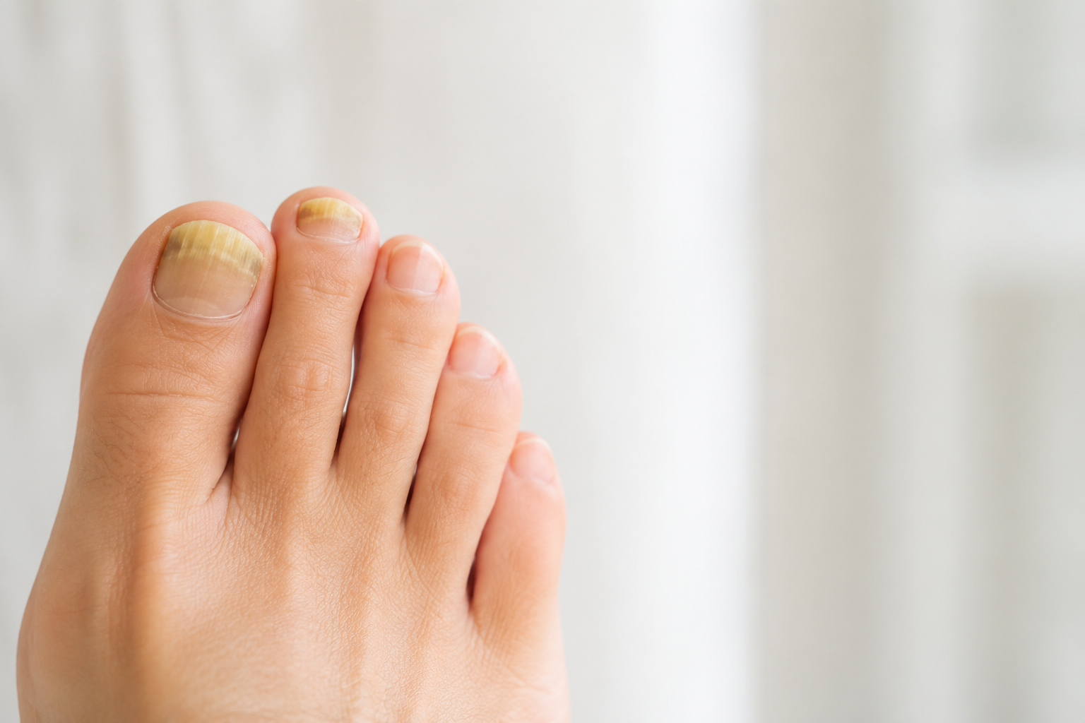 Toenail Fungus.