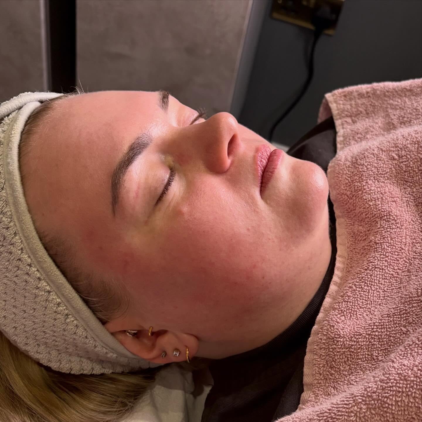 ✨𝟔 𝐬𝐭𝐞𝐩 𝐡𝐲𝐝𝐫𝐨 𝐟𝐚𝐜𝐢𝐚𝐥 ✨ 

75 minutes of ☁️𝐒𝐤𝐢𝐧 𝐇𝐞𝐚𝐯𝐞𝐧 ☁️

Using 6 different technologies 

𝐇𝐲𝐝𝐫𝐨𝐩𝐞𝐞𝐥 - AHA &amp; BHA products are used to dissolve keratin and deep cleanse the pores to remove blackheads and smooth th