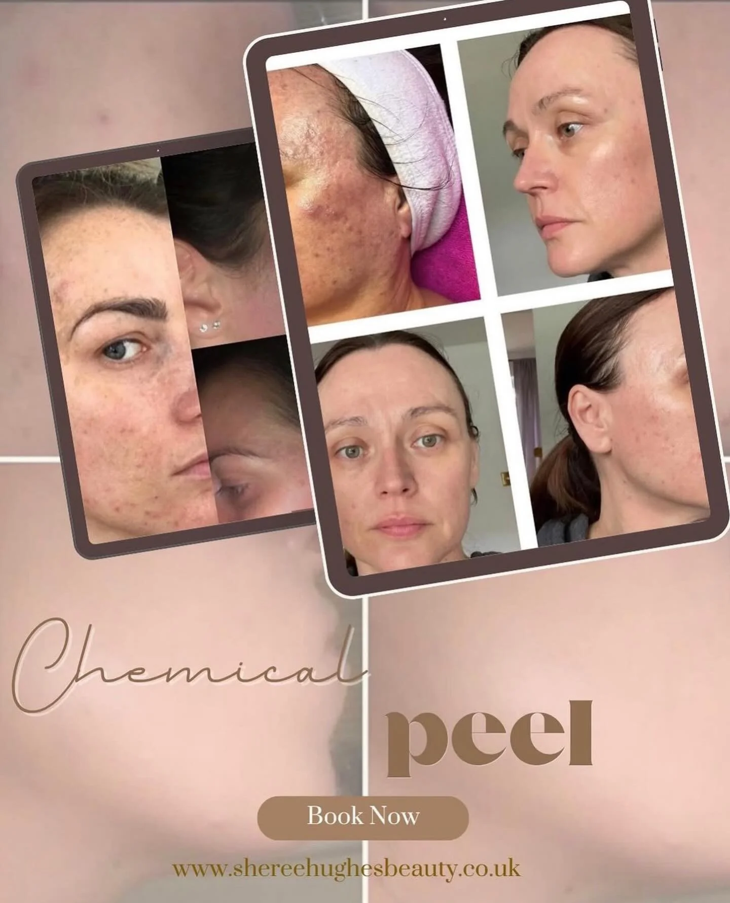 ✨𝐒𝐩𝐞𝐜𝐢𝐚𝐥 𝐨𝐟𝐟𝐞𝐫 ✨

For the month of 𝐀𝐩𝐫𝐢𝐥 I will be offering all chemical peel treatments with a 𝐜𝐨𝐦𝐩𝐥𝐢𝐦𝐞𝐧𝐭𝐚𝐫𝐲 20 minute LED light therapy to enhance the results of your peel ✨

What is a chemical peel? 

A chemical peel 