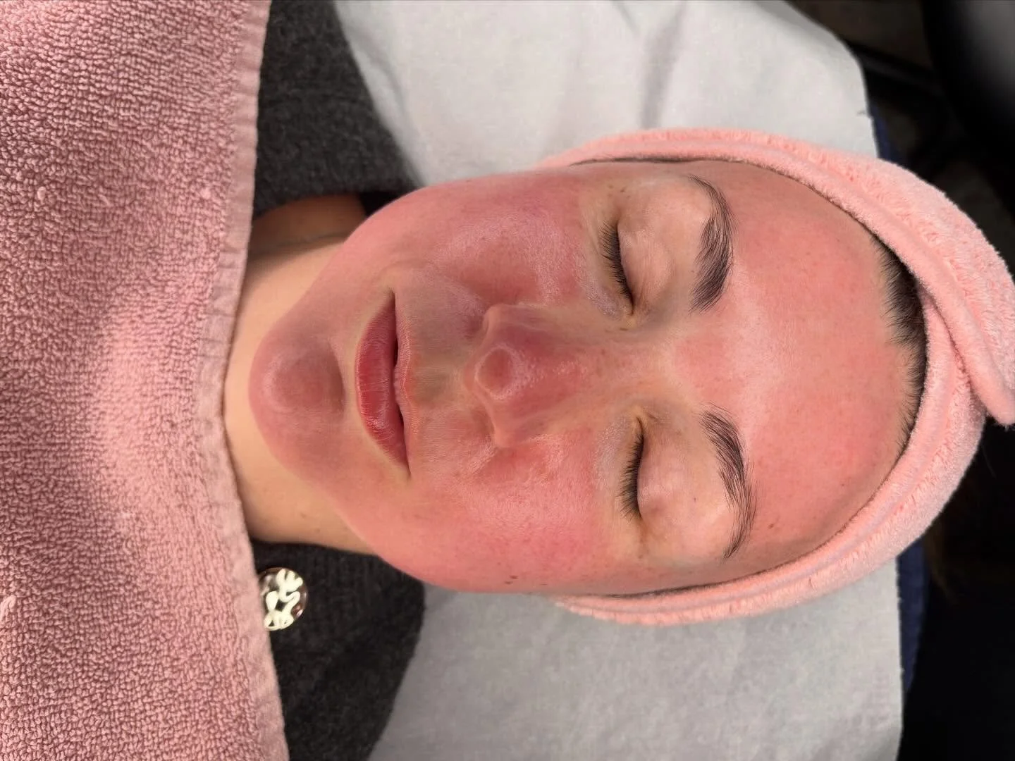 Skin needling triggers a necessary controlled inflammatory healing response 🔴 This reaction signifies increased blood flow to the skin, which initiates collagen and elastin production for rejuvenation✨ #microneedling #medicalgradeskinneedling #rosse