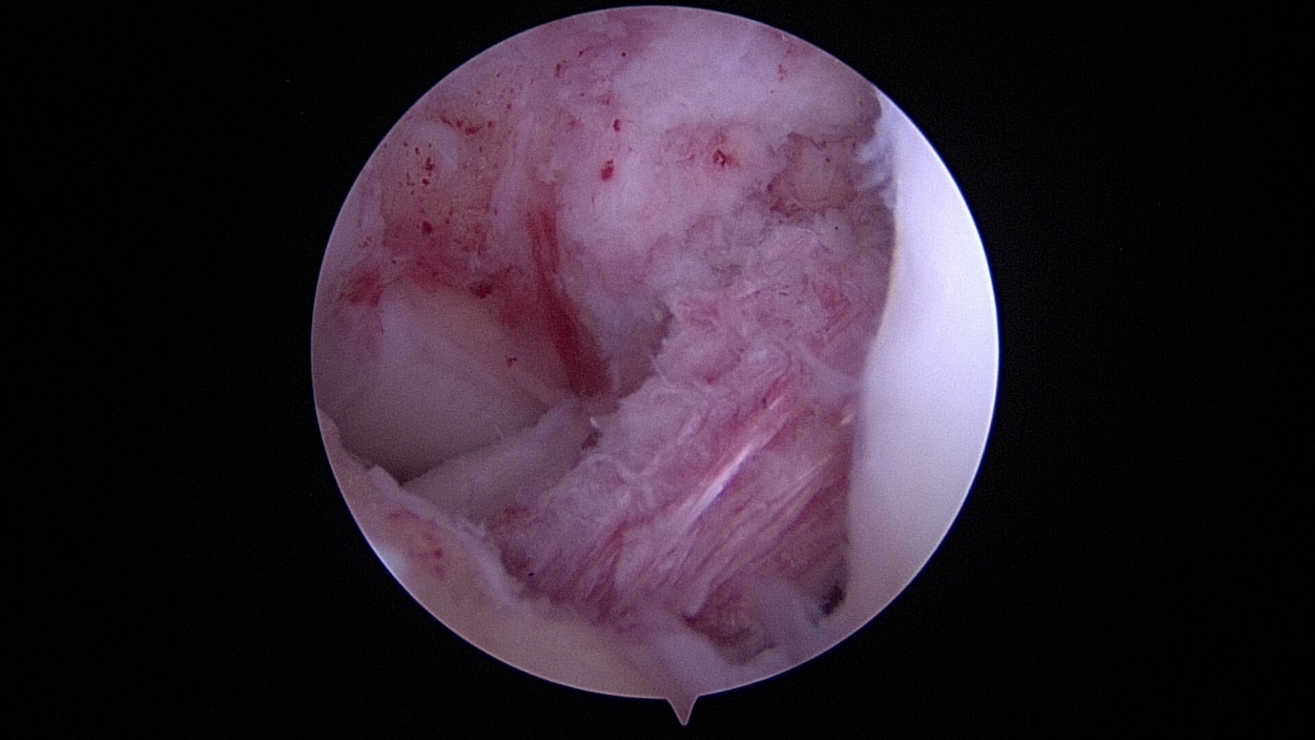 Anterior Cruciate Ligament Tears and Reconstruction