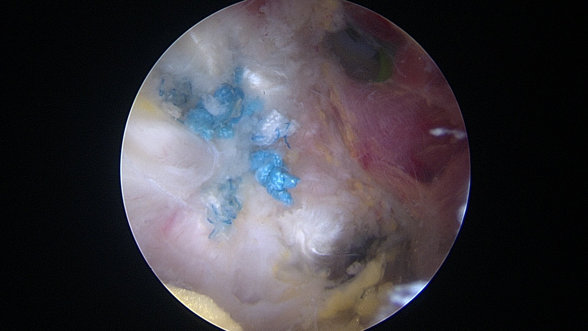 Hamstring Tendon Tears and Surgical Repair