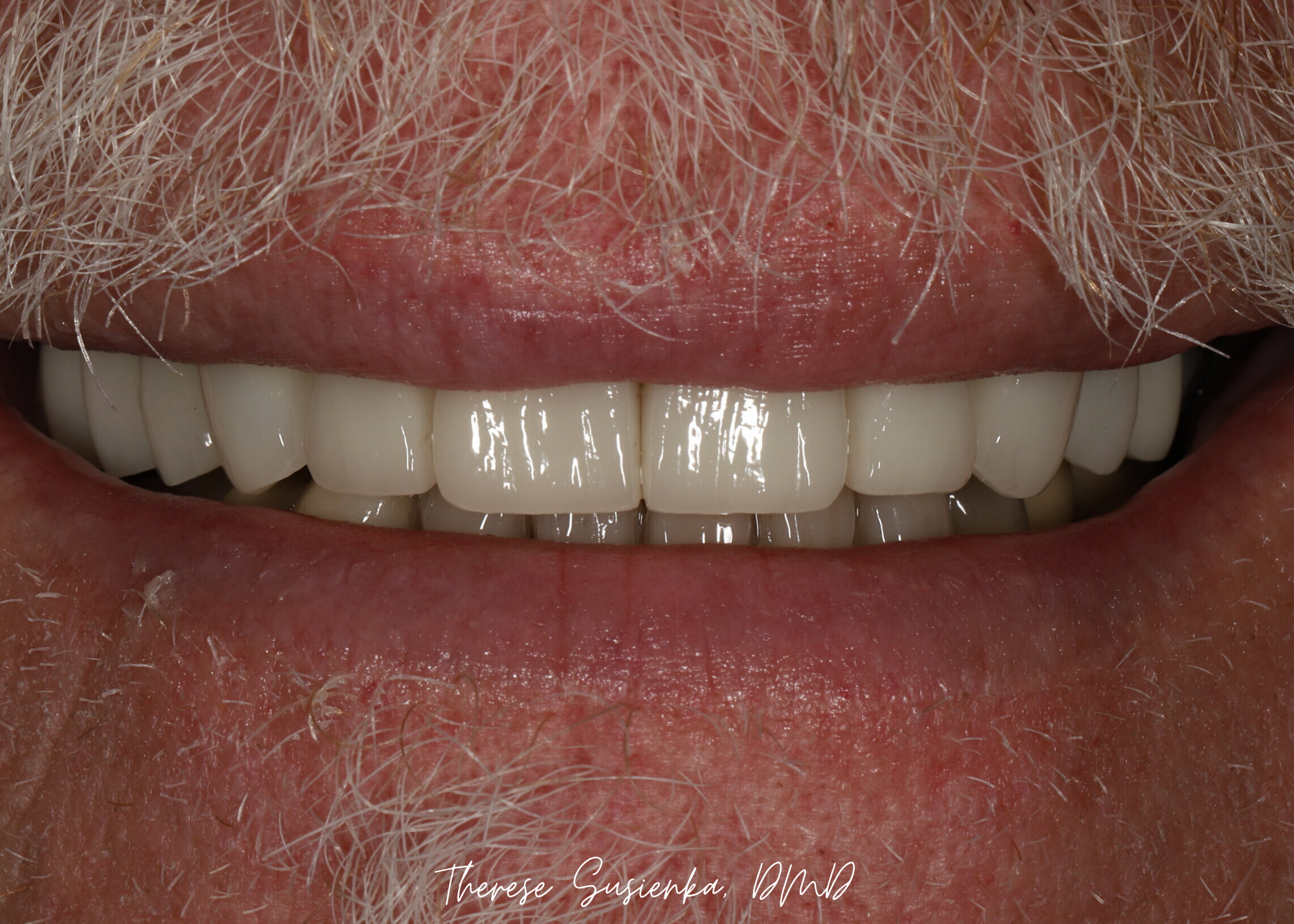 An added bonus to Doug was the significant cosmetic improvement to his smile. Because we planned this outcome with proper function of his teeth and jaw joints in mind, his handsome new smile was functionally balanced to protect his teeth from rapid b