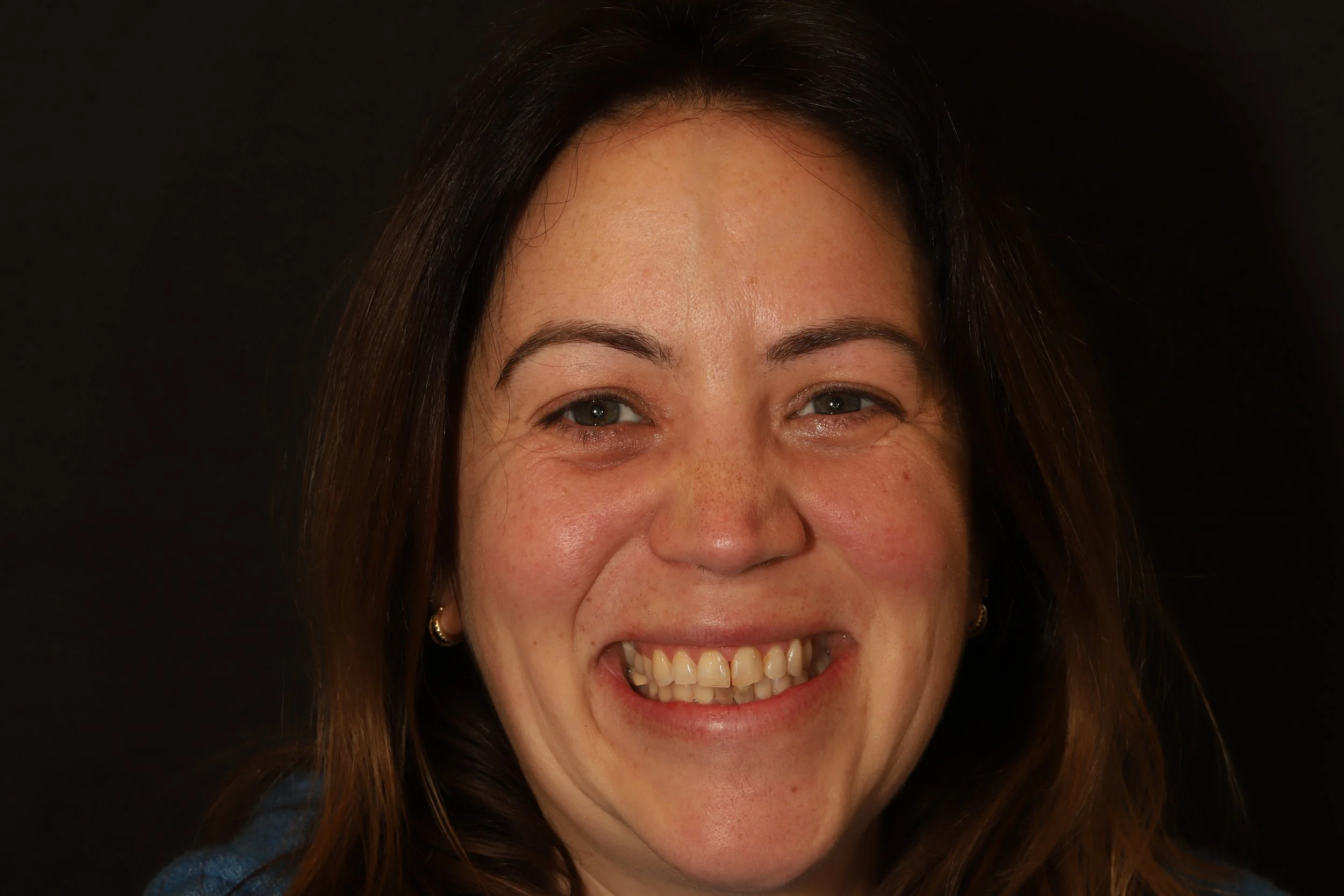 Alyssa was embarrassed about her smile, and traumatic past dental experience left her anxious about how to fix it. 