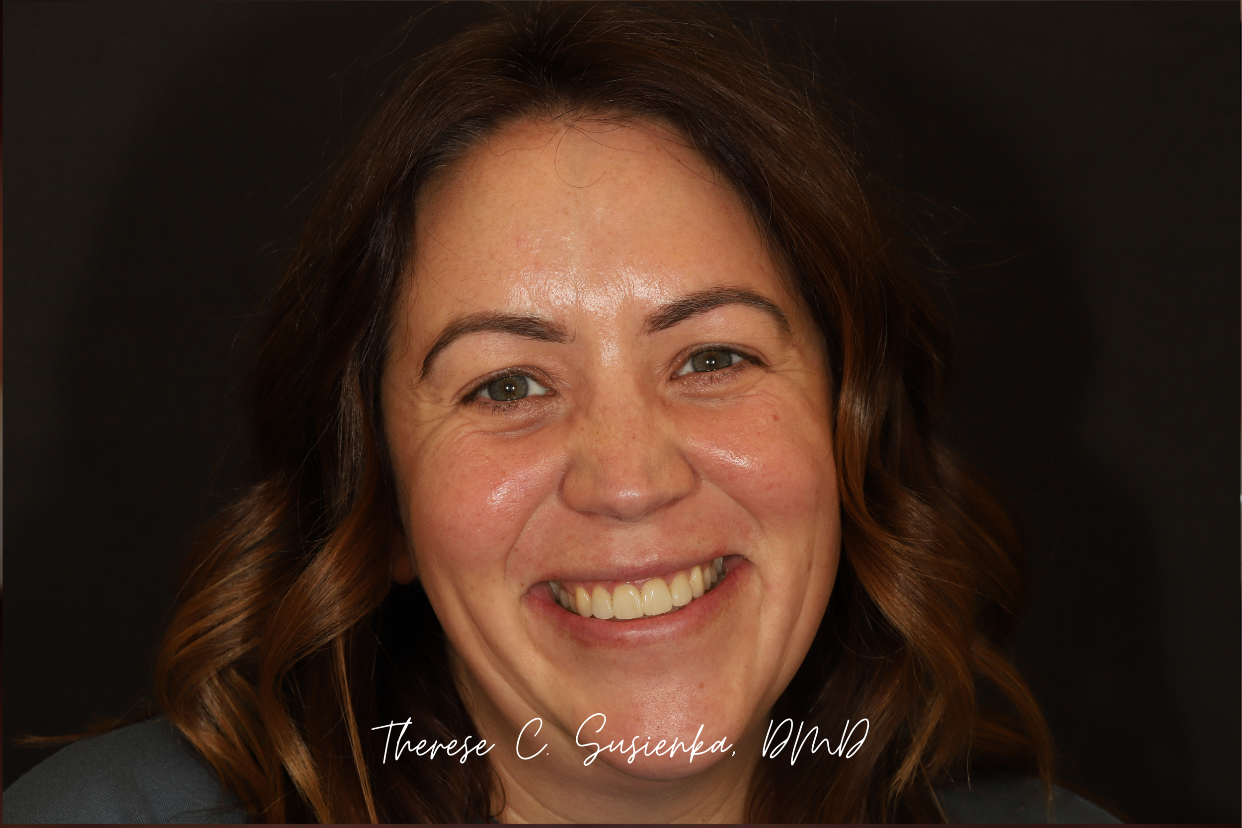 By designing her smile with the full face, Dr. Therese could not only deliver a harmonious, natural looking result, but also preview the design before starting treatment.